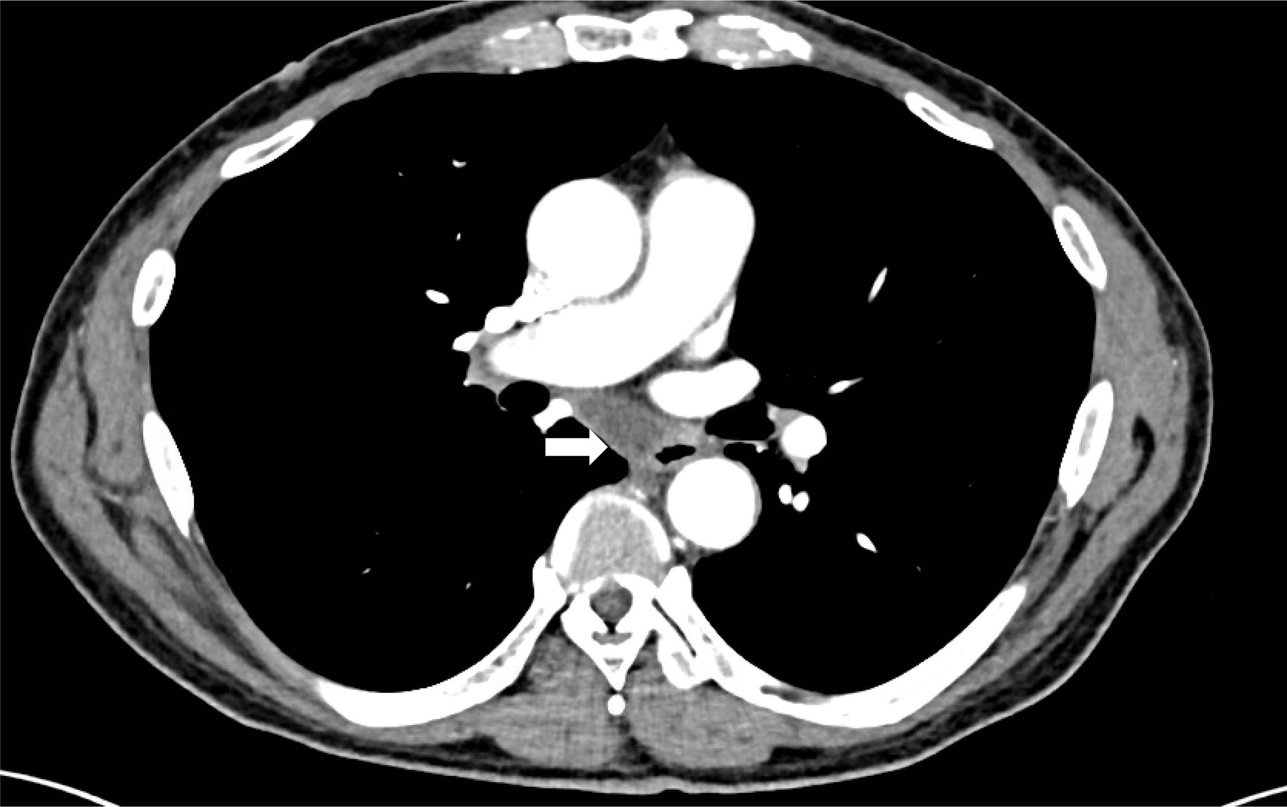Esophageal duplication cyst. Axial contrast-enhanced CT image demonstrates a well-defined, unilocular, thin-walled cystic lesion in the posterior mediastinum in relation to the right lateral esophageal wall, consistent with an esophageal duplication cyst.