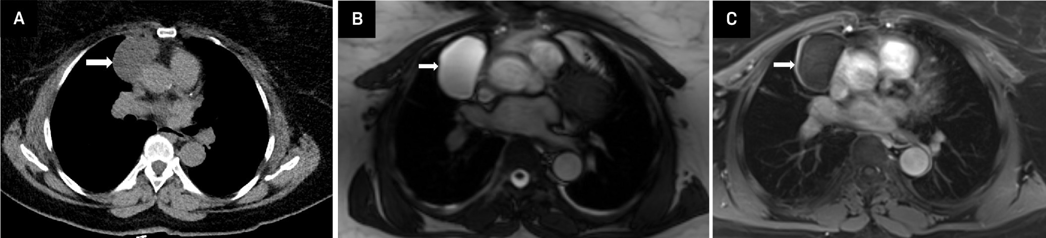 Pericardial cyst. (A) Axial noncontrast CT image demonstrates a well-circumscribed, unilocular, cystic mediastinal lesion abutting the ascending thoracic aorta with thin, imperceptible walls. (B) Axial T2-weighted MRI demonstrates homogeneous hyperintense signal of the cyst contents, consistent with simple serous fluid. (C) Axial T1-weighted fat-suppressed post-contrast MRI image confirms peripheral enhancement of the lesion with absence of solid components within the lesion, consistent with a simple pericardial cyst.