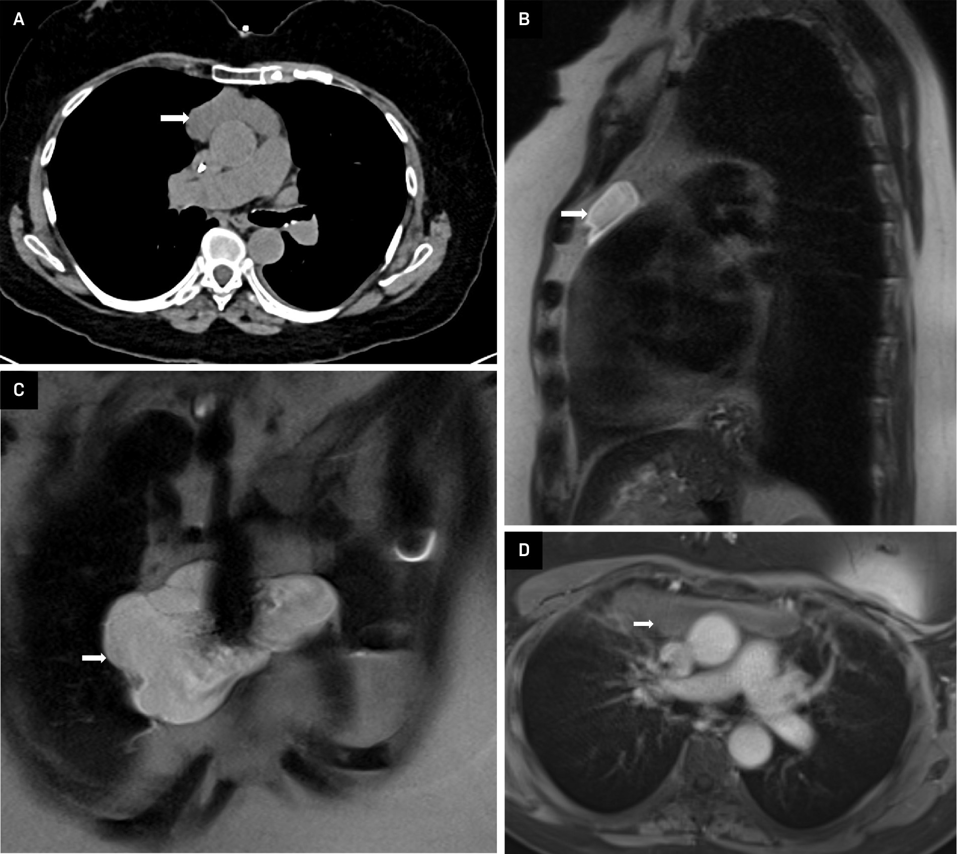 Thymic cyst. (A) Axial noncontrast CT chest image shows a low-attenuation lesion in the prevascular space. (B, C) Sagittal and coronal T2-weighted MRI images demonstrate the craniocaudal extent of the multilocular lesion with heterogeneous T2 signal, reflecting variable fluid composition across the cystic locules with internal septations consistent with a thymic cyst. (D) Axial post-contrast T1-weighted MRI image shows no enhancement of the lesion in the prevascular mediastinum.