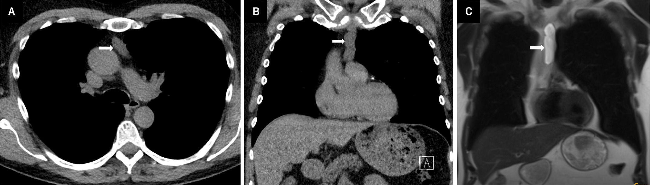 Thymic cyst. (A, B) Axial and coronal noncontrast CT images demonstrate a well-defined, low-attenuation cystic lesion in the prevascular anterior mediastinum. (C) Similar lesion on coronal T2-weighted MRI sequence shows hyperintense lesion consistent with thymic cyst.