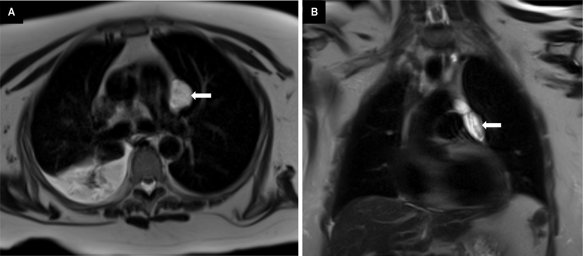 Lymphangioma. (A, B) Axial and coronal T2-weighted MRI sequences showing a T2 hyperintense visceral mediastinal lesion abutting the pulmonary artery, which represents lymphangioma.