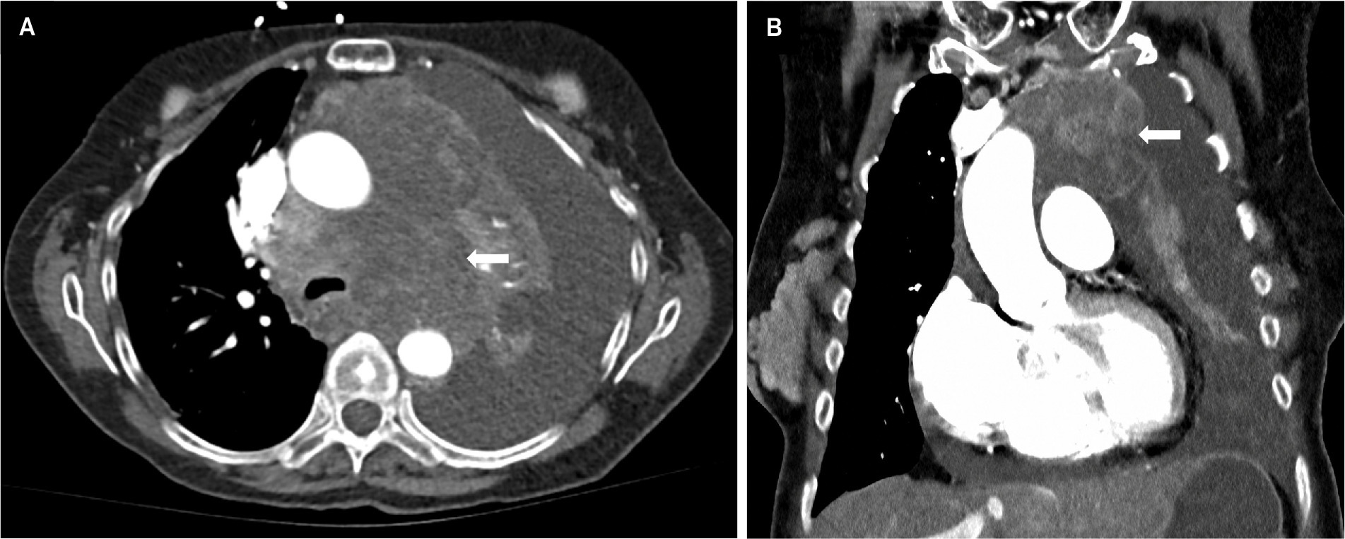 Necrotic mediastinal lymph nodes. (A, B) Axial and coronal contrast CT images show conglomerated enlarged mediastinal lymph nodes in the prevascular and visceral mediastinum. Extensive necrosis of lymph nodes is seen, mimicking complex cystic mediastinal lesions.