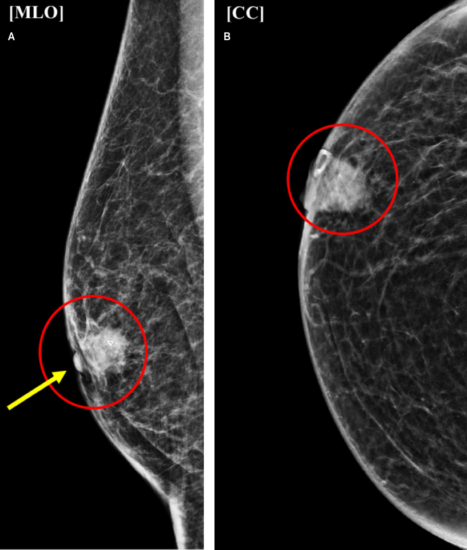 Mediolateral oblique (MLO) (A) and craniocaudal (CC) (B) diagnostic mammogram views of the right breast. Palpable marker best seen on CC view (B) was placed over the lump as indicated by the patient. Within this region, there is a high-density irregular mass with indistinct margins (red circles). There is mild right nipple retraction (yellow arrow).
