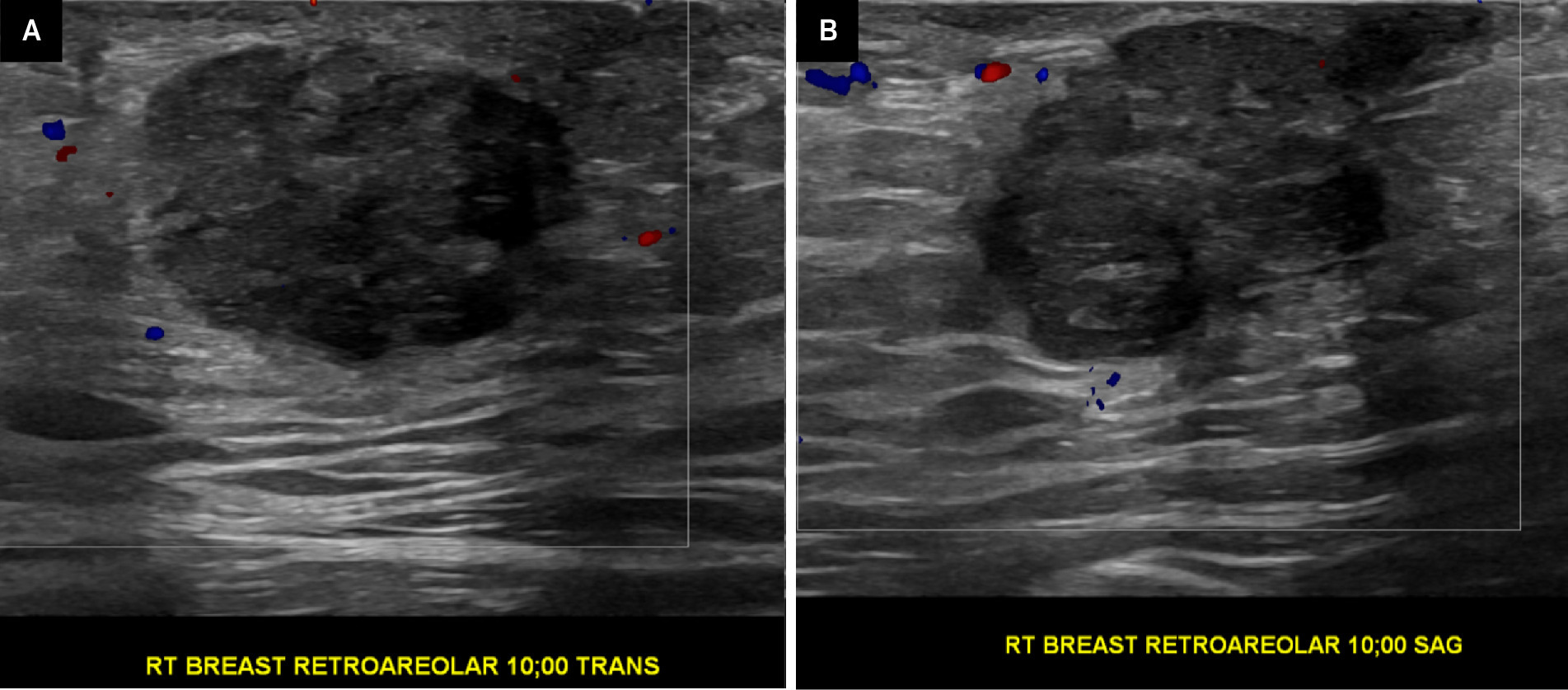 Targeted US evaluation of the right retroareolar region of concern transverse (A) and sagittal (B) color flow images demonstrates an irregular hypoechoic mass with microlobulated margins. Internal vascular flow was not appreciated.