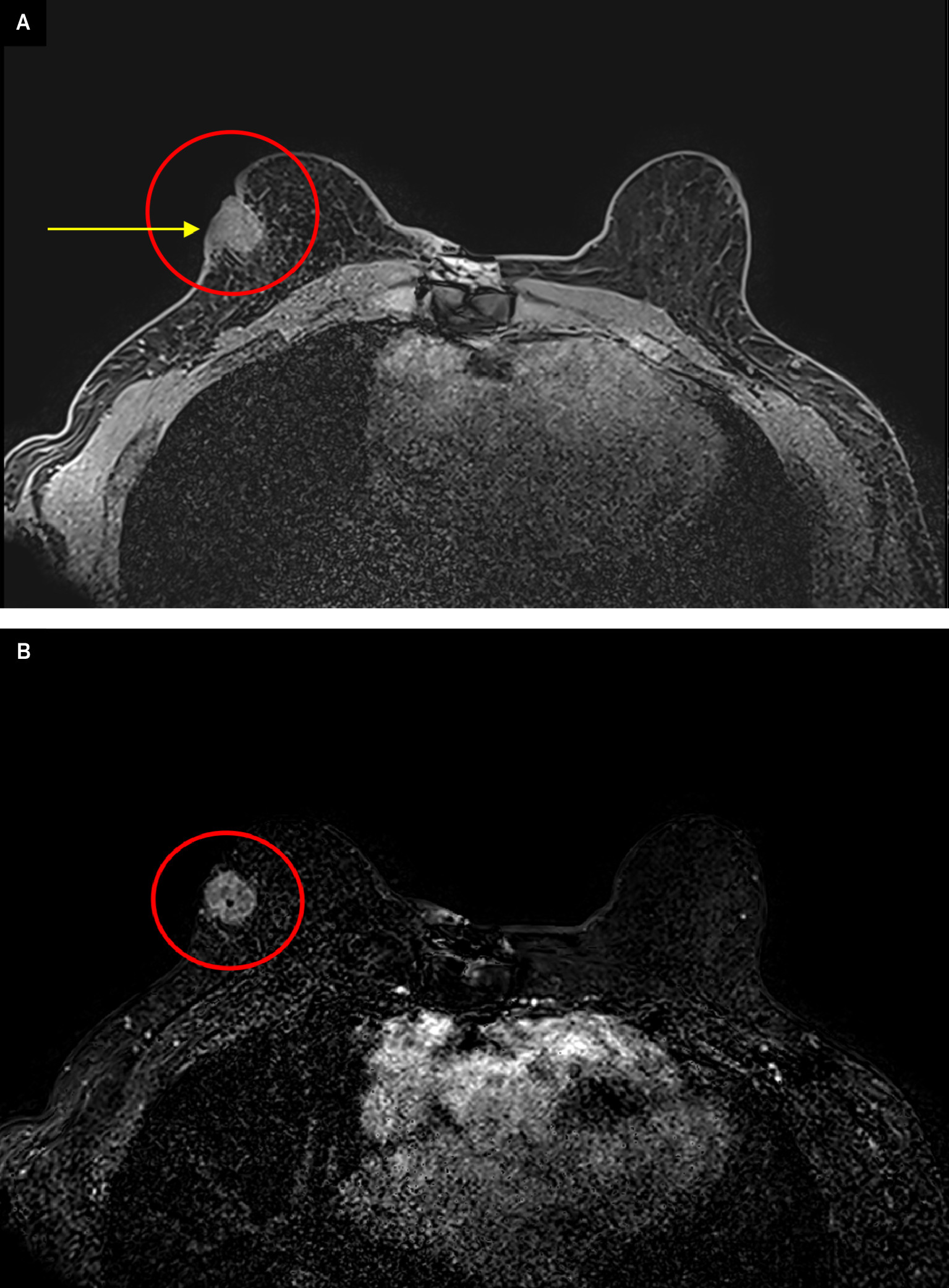Contrast-enhanced breast MRI precontrast (A) and initial postcontrast subtraction (B) completed 1 month after initial diagnostic mammogram and US demonstrated an enhancing mass with overlying skin thickening (yellow arrow). No additional suspicious enhancing findings were identified.