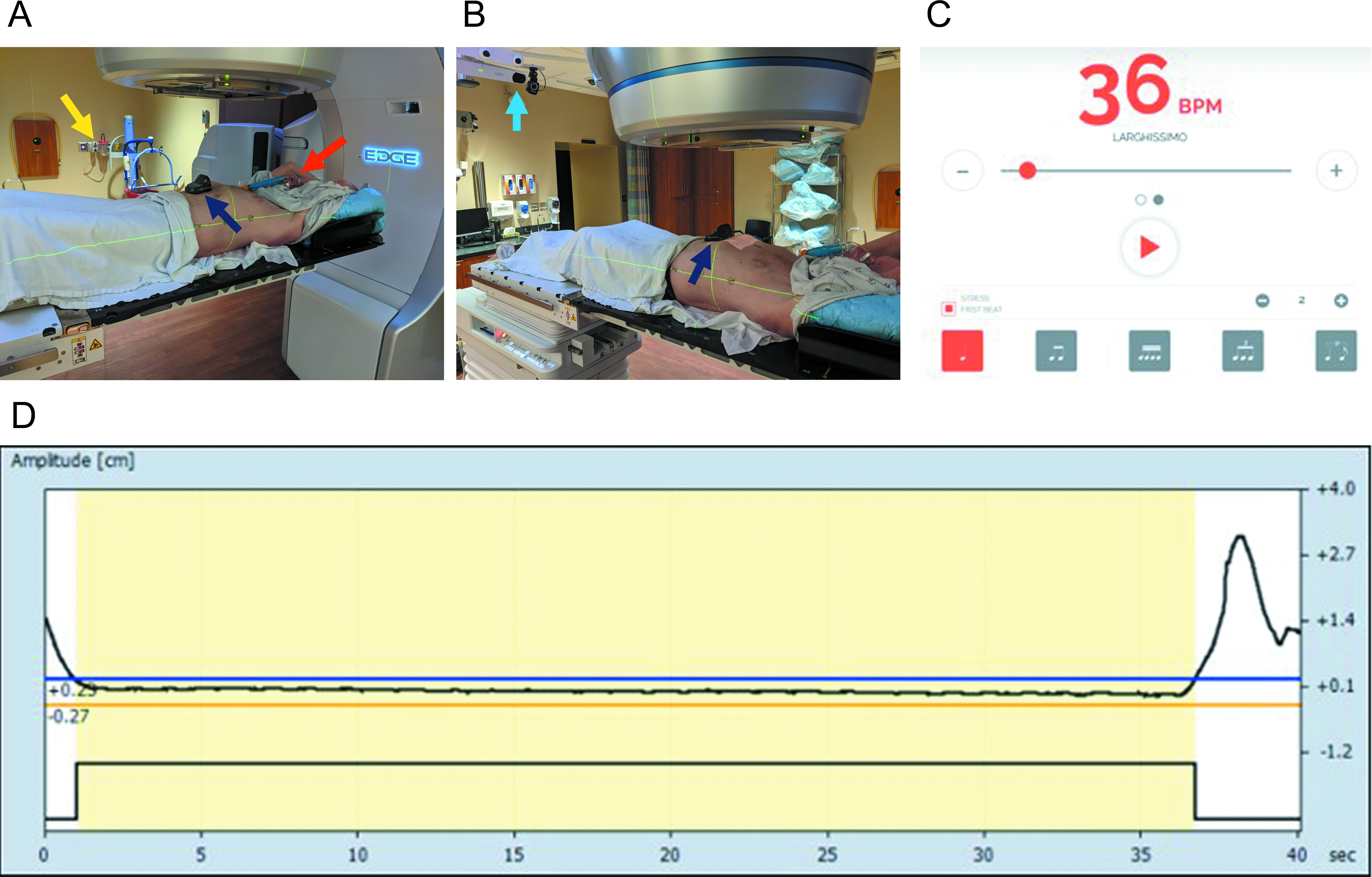 Implementation details of the supplemented expiratory breath hold technique (EBHsupp). Supplemental oxygen was delivered at 50% FiO2 via a Venturi mask and appropriate adapter (red arrow) connected to in-house oxygen flowmeters (yellow arrow) in the treatment delivery vault (A). Varian’s Real-Time Position Management (RPM) system was used to track patient respiratory motion with an infrared tracking camera (light blue arrow) and reflective marker (dark blue arrow) placed on the patient’s abdomen (B). Patients were encouraged to breathe at a respiratory rate of 18 breaths/min with the use of an online metronome. The metronome was set at 36 beats/min with stress on the first beat so there would be a distinct sound cue for both the start of inhalation and the start of exhalation (C). An example of breath-hold tracing during patient treatment via the RPM system is shown (D). Permission was given by a patient volunteer for the use of photographs in this article.