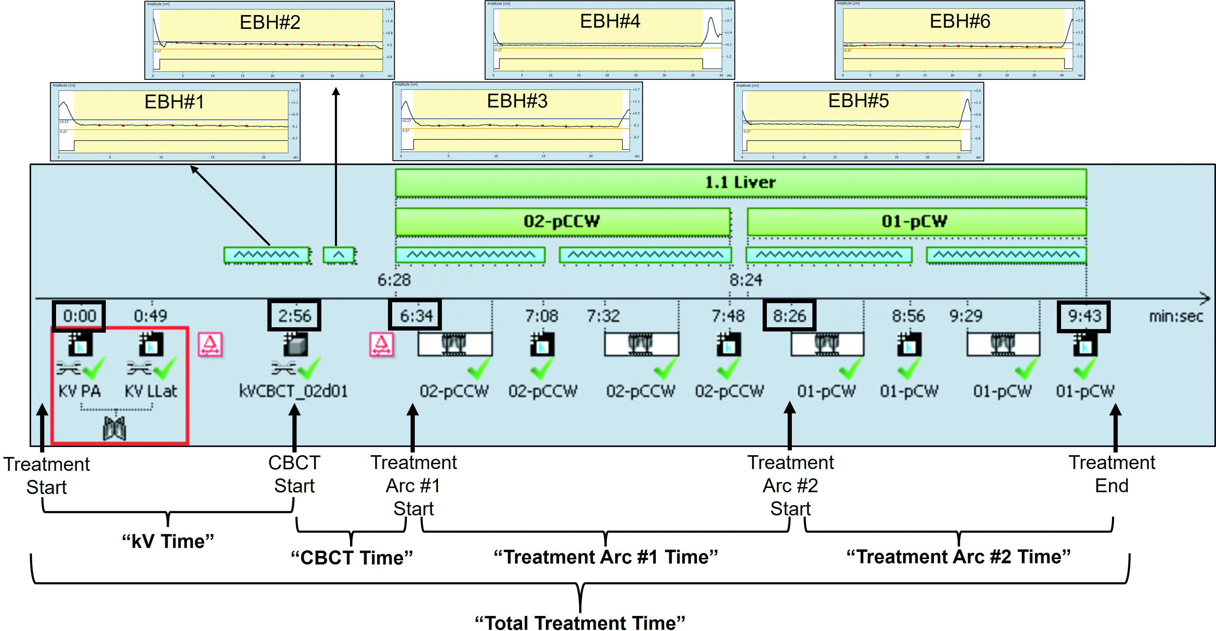 Treatment timeline example and definition of time points. The shaded gray area shows an example “Session Timeline” screenshot from Varian Eclipse treatment planning software from a patient treated with a supplemented expiratory breath-hold (EBH) technique. The individual EBHs performed by the patient during cone-beam CT (CBCT) and delivery of treatment arcs are shown in the amplitude tracings at the top of the figure (EBH#1 to EBH#6). Treatment time definitions are shown toward the bottom of the figure (and are described in the “Materials and Methods” section).