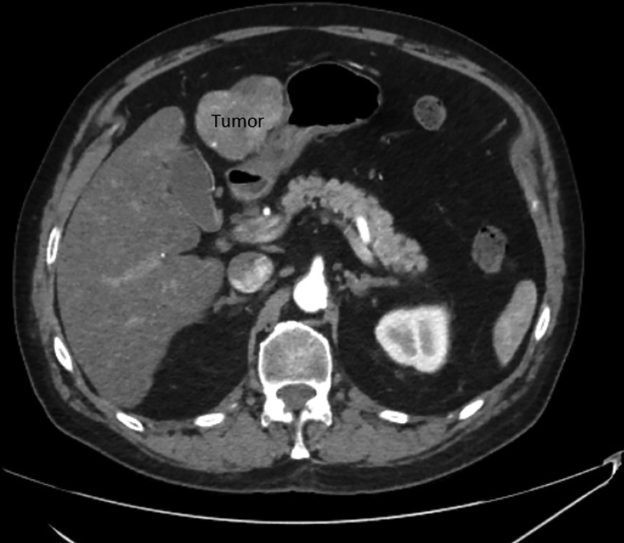 Patient’s initial CT scan showing active disease within segments 2 and 3 of the liver measuring up to 7 cm.