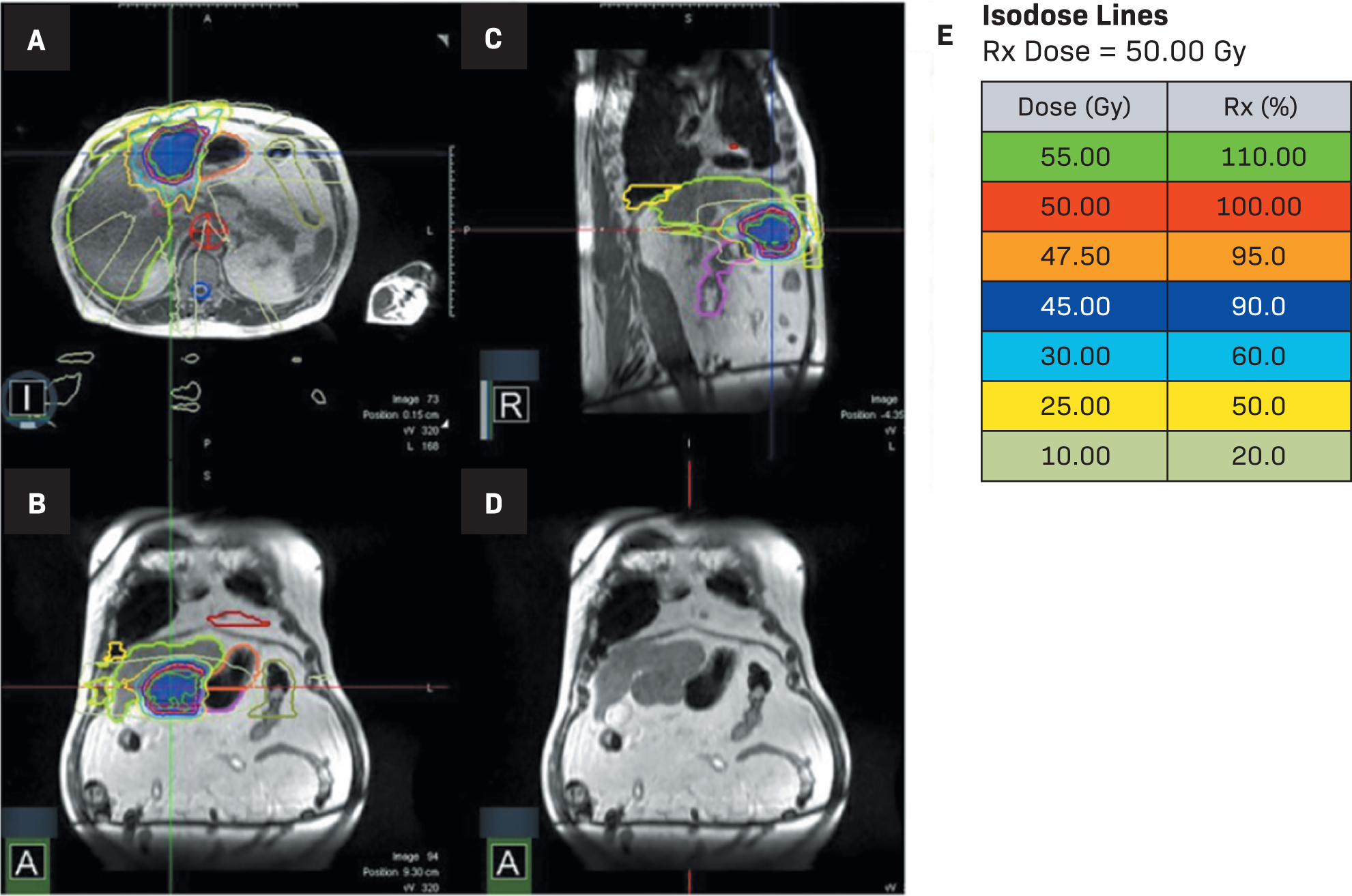 Isodose lines for MR-guided stereotactic body radiation therapy (MRgSBRT) treatment (A-E). (L= left, R = right, A in the bottom left corners = anterior)
