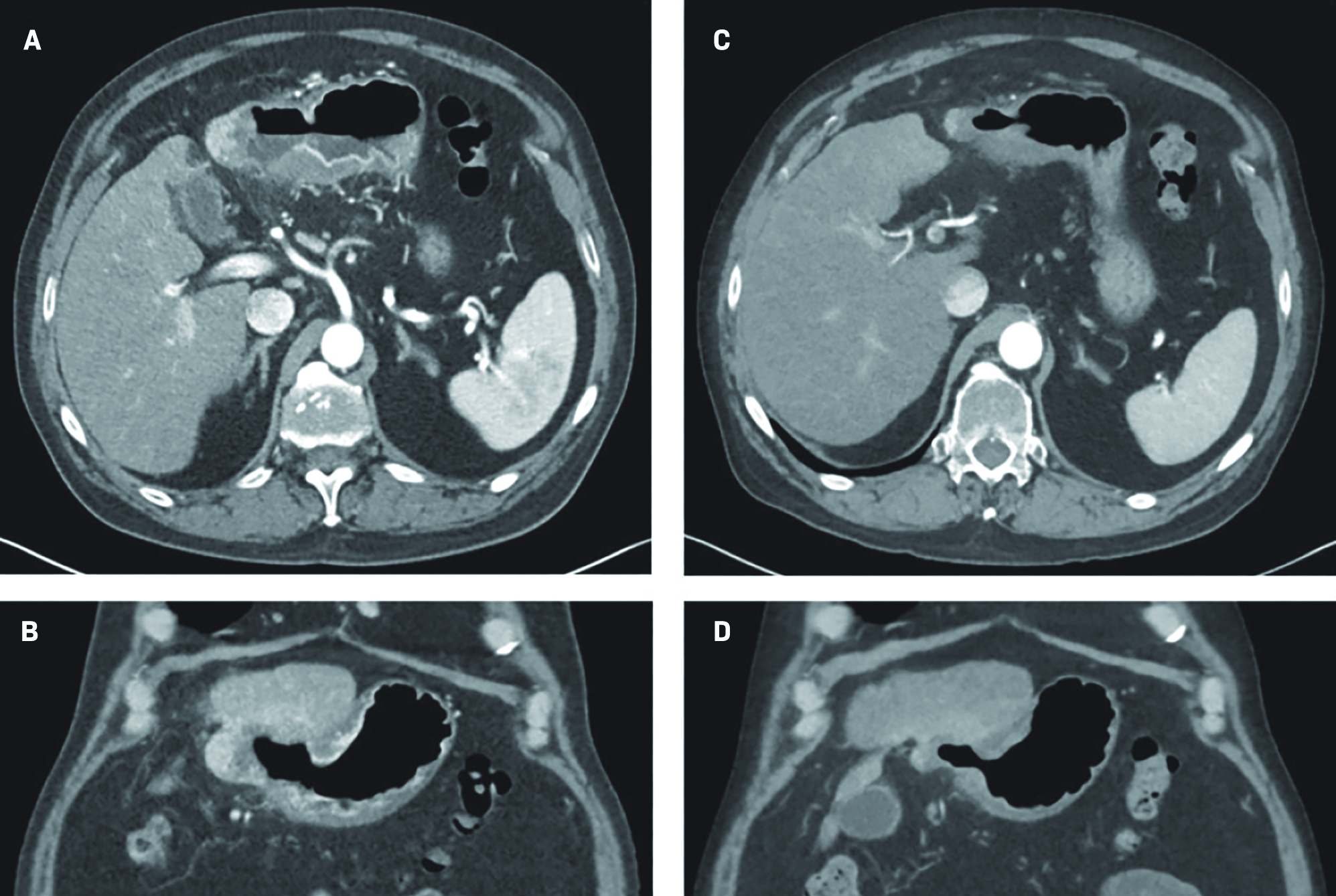 A 3-mo follow-up CT scan showing axial (A) and coronal views (B). A 6-mo follow-up CT scan showing axial (C) and coronal views (D).