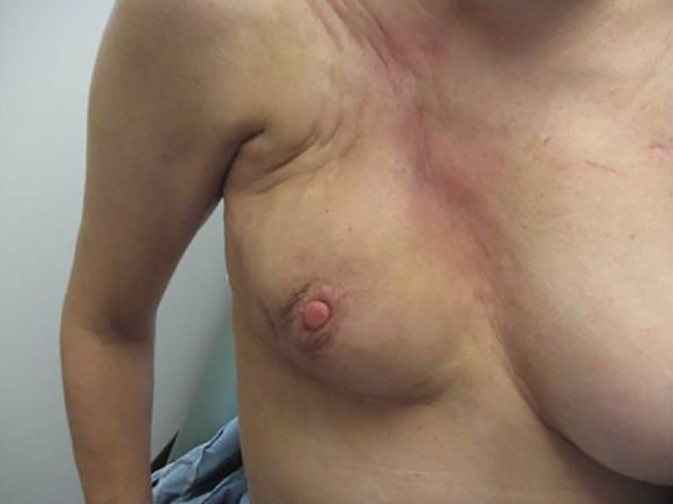 Significant fibrosis and poor cosmesis seen following radiation.