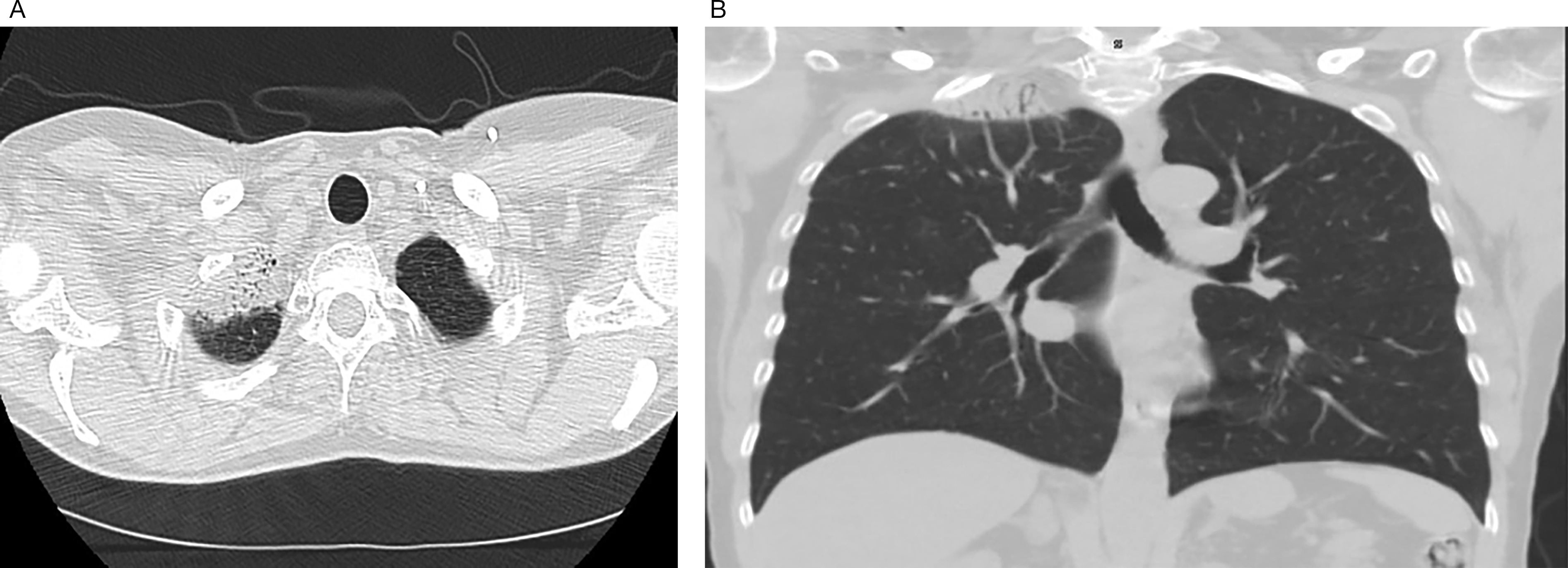 Apical scarring of the right lung following radiation as seen on an axial view (A). Apical scarring of the right lung following radiation as seen on a coronal view (B).