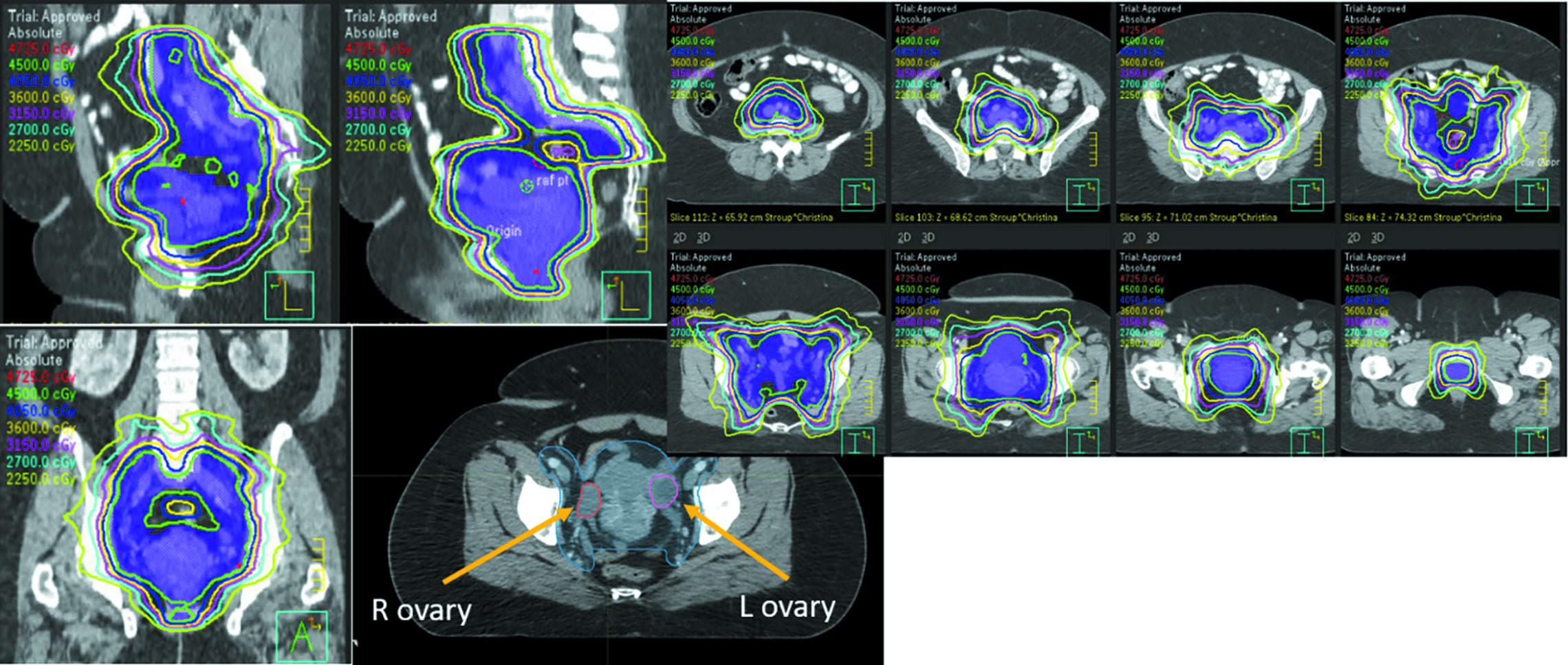 A typical pelvic radiation therapy plan using intensity-modulated radiation therapy, with ovaries identified on CT.