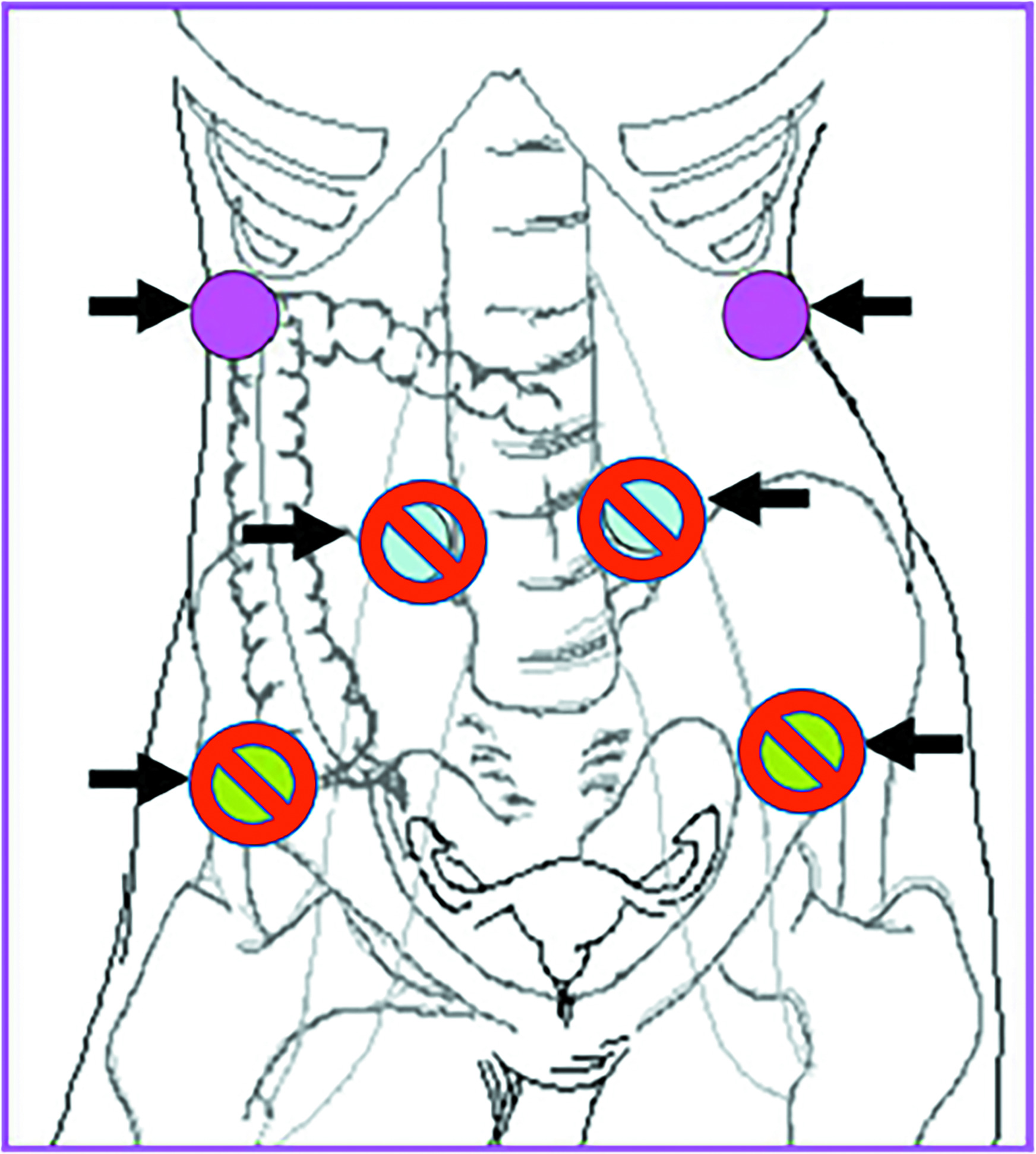 Ideal location of transposed ovaries that are high and lateral in the abdomen (pink). Less ideal locations are also shown (crossed out).