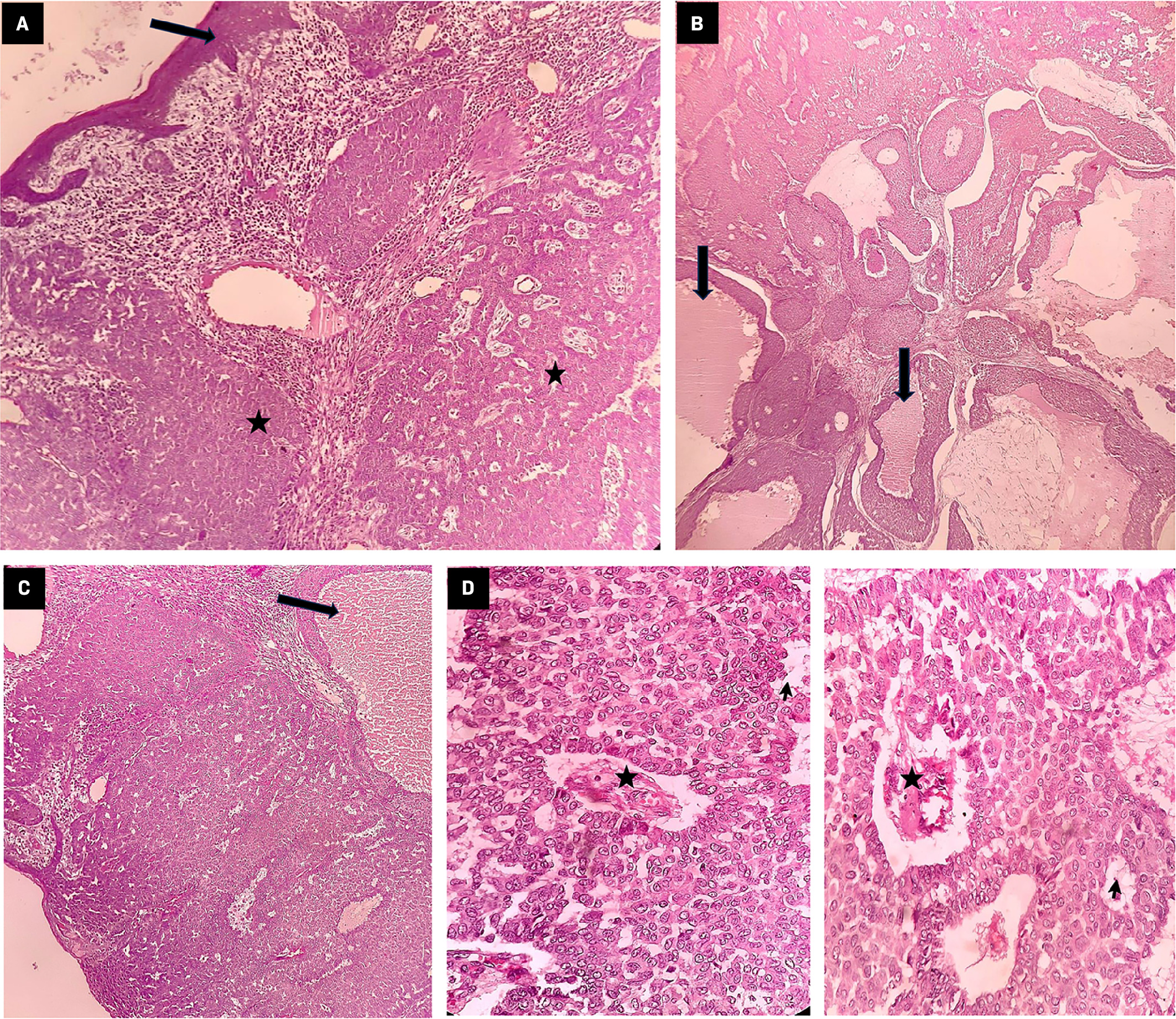 Section shows tumor-infiltrating dermis (star) arranged in nests and a glandular pattern with overlying intact epidermis (arrow) (hematoxylin and eosin [H&E] × 40) (A). Tumor shows the formation of duct-like structures (arrows) filled with secretions suggestive of sweat gland differentiation (H&E × 40, H&E × 100) (B). Tumor shows the formation of duct-like structures (arrows) filled with secretions suggestive of sweat gland differentiation (H&E × 100) (C). Both figures: tumor is composed of round to oval cells arranged in solid, papillary (star) and tubular (arrow) patterns (H&E × 400) (D).