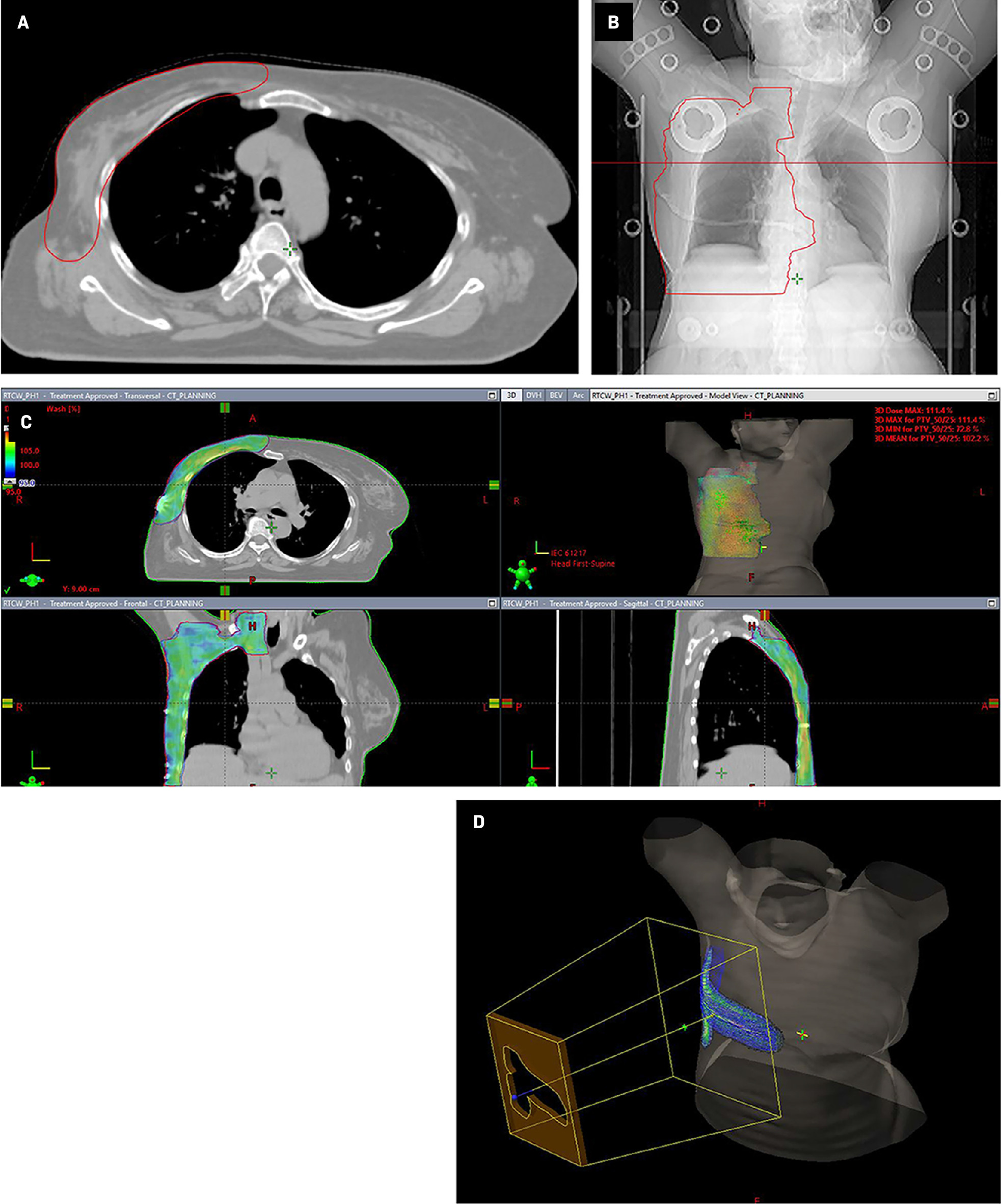 Radiation therapy treatment planning simulation CT image and primary treatment volume contour as visible ondigitally reconstructed radiographs (A, B). Radiation therapy dose distribution in color wash covering the chest wall, axilla, and supraclavicular nodal region (C). Electron-beam radiation therapy plan showing dose distribution covering the chest wall scar and drain sites (D).