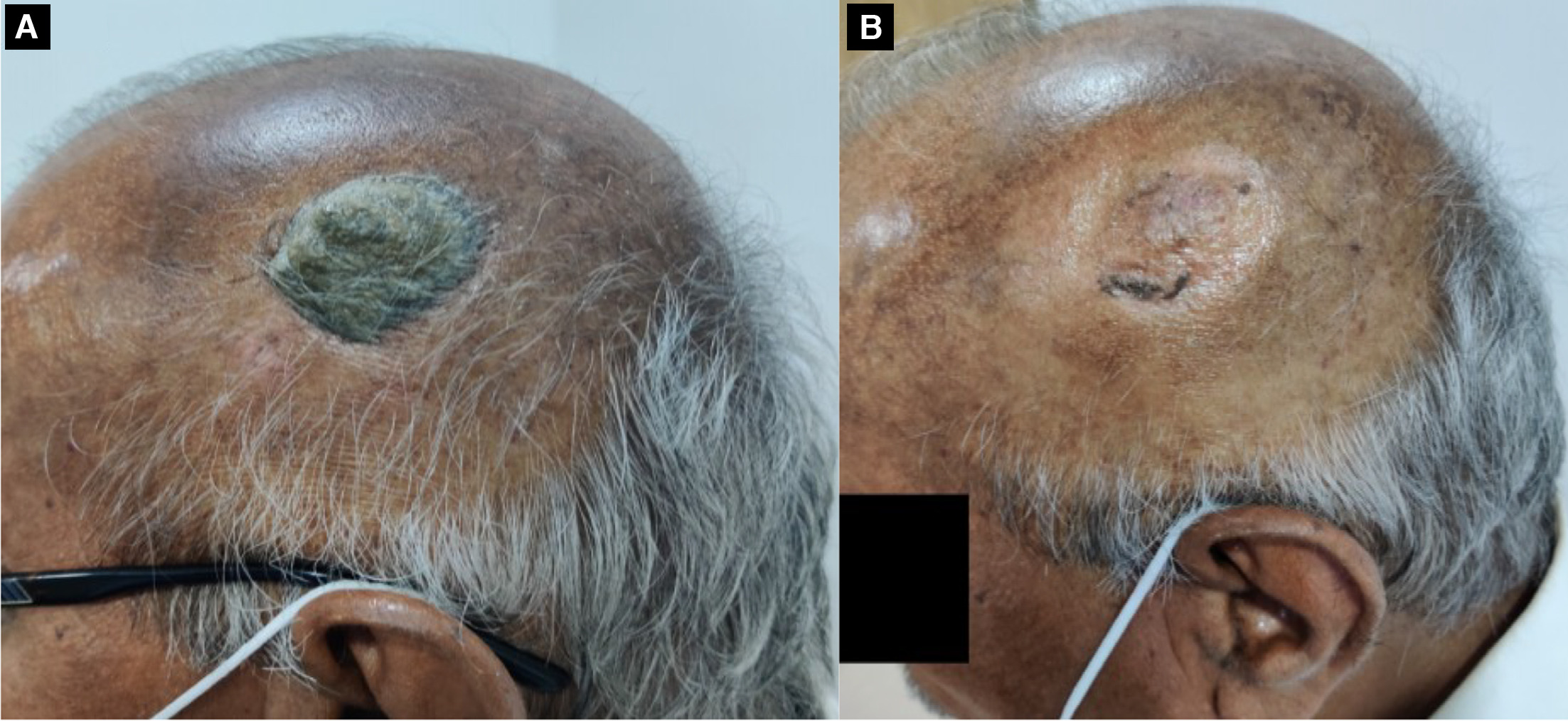 Clinical photographs of pretreatment (A) and post-treatment (B) showing complete response.