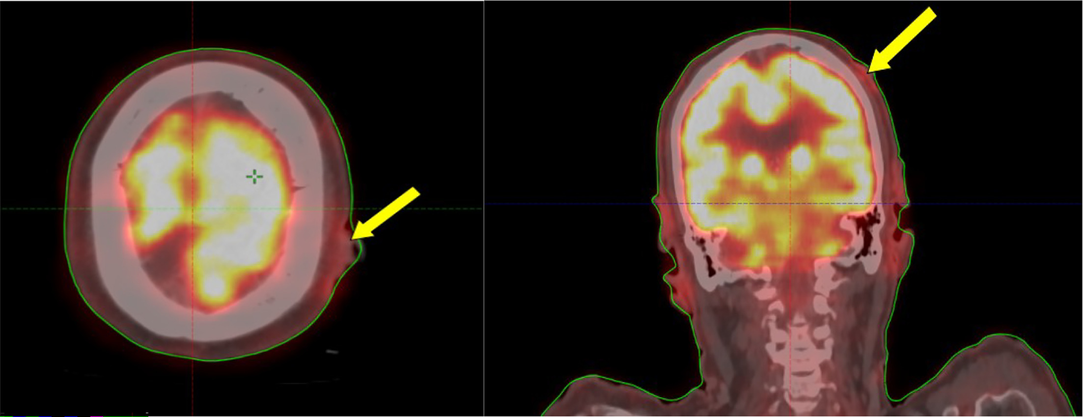 Pretreatment positron emission tomography/computed tomography (PET/CT) showing the left scalp lesion (yellow arrow).