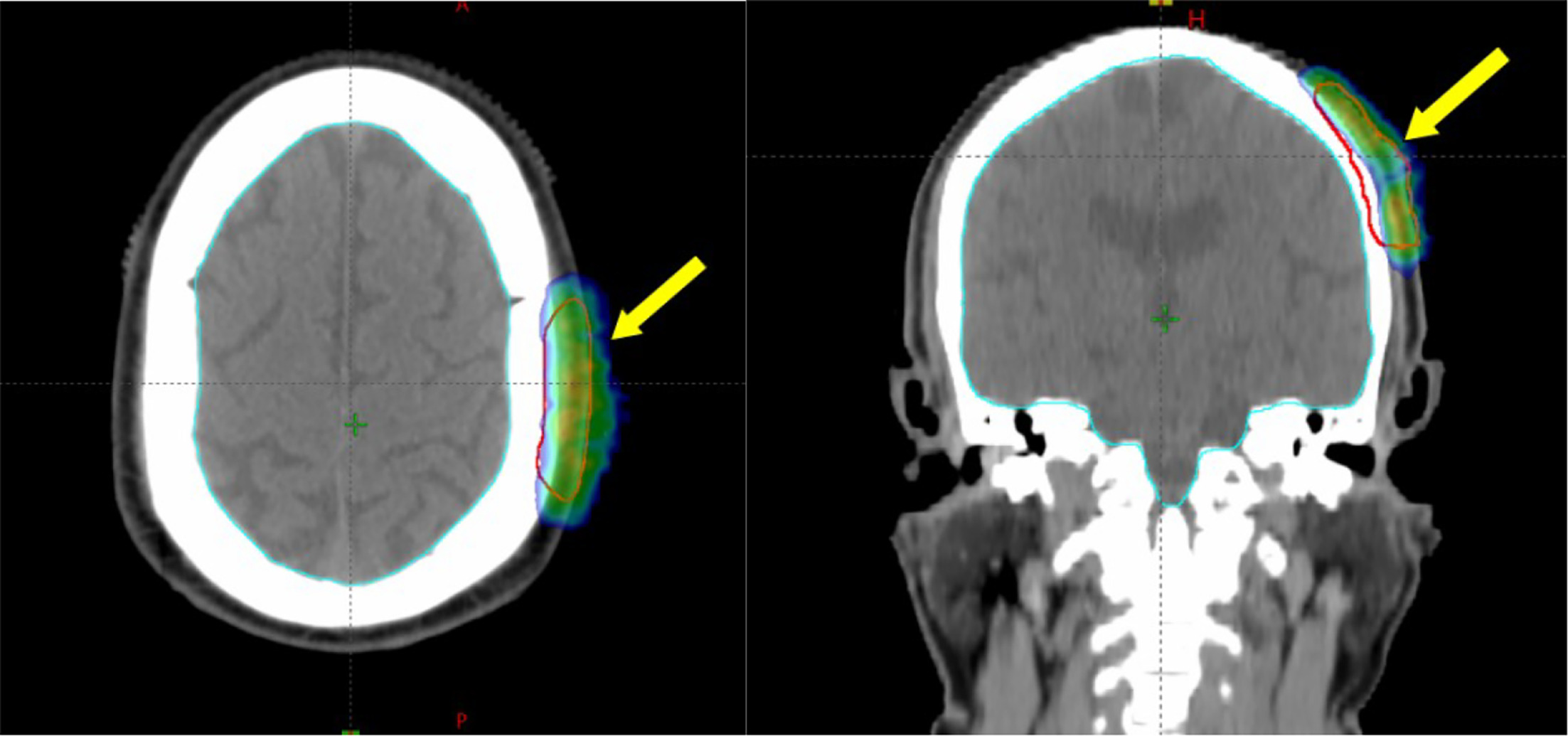 Electron-beam treatment plan showing dose coverage (green and blue color wash) of the left parietal scalp lesion. The planning target volume (PTV) is contoured in red.