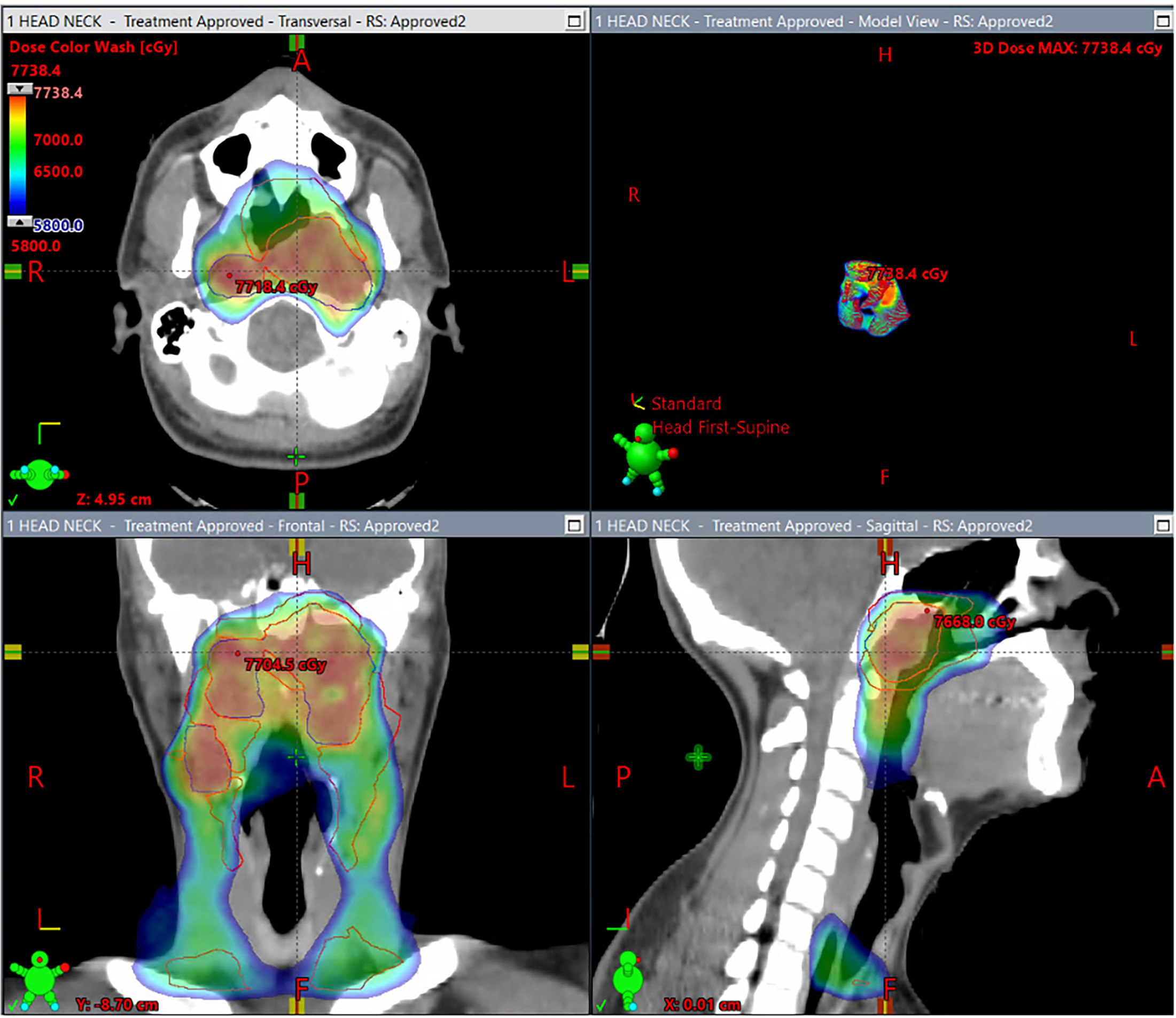 Dose color wash showing the patient’s initial treatment that includes treatment to the primary tumor and bilateral neck lymph node levels.