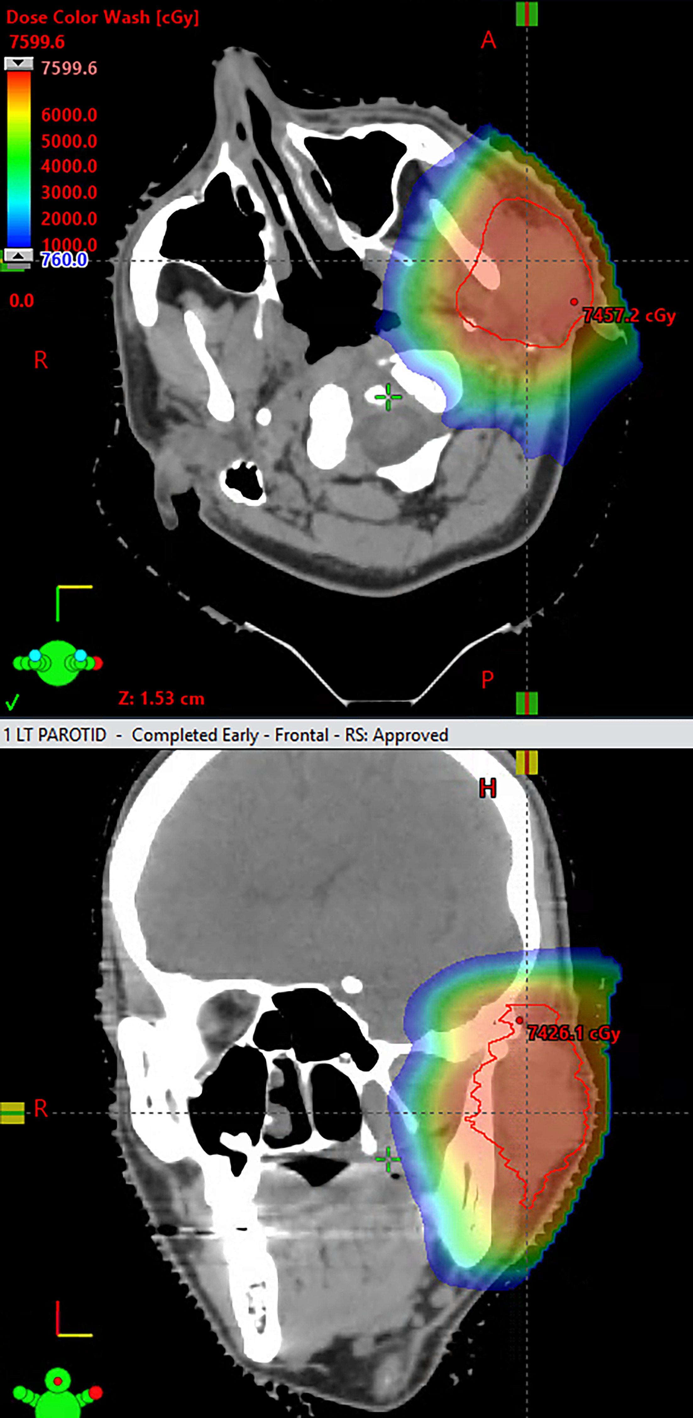 Dose wash of the proton radiation plan of the patient’s left parotid recurrence.