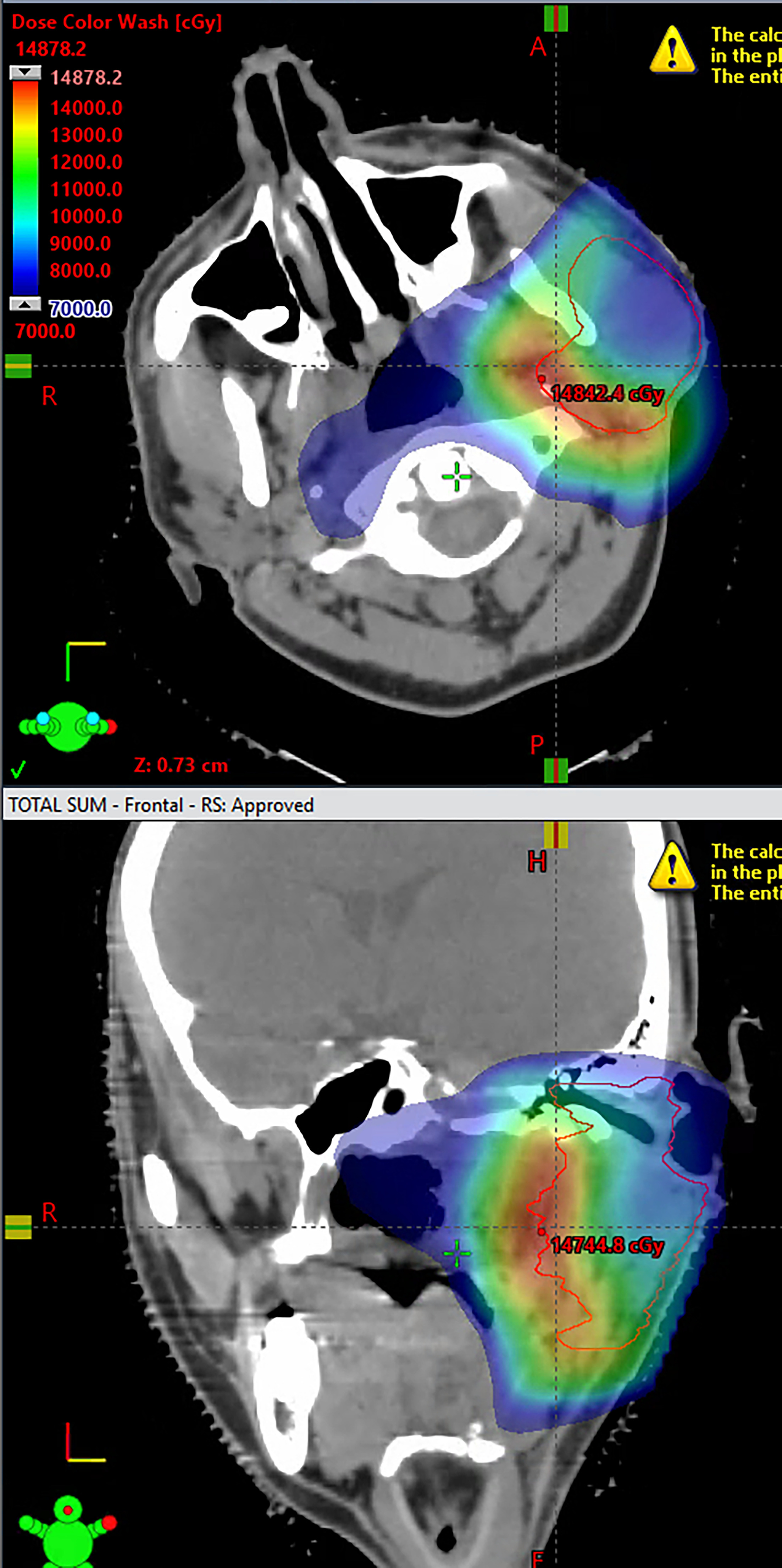 Dose wash of the proton therapy plan sum.