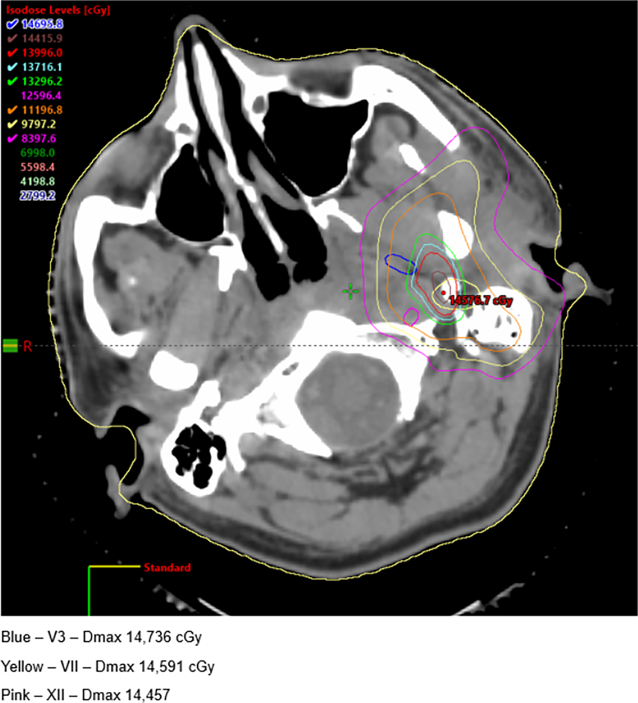 Paths of cranial nerves V3, VII, and XII through the high-dose region.