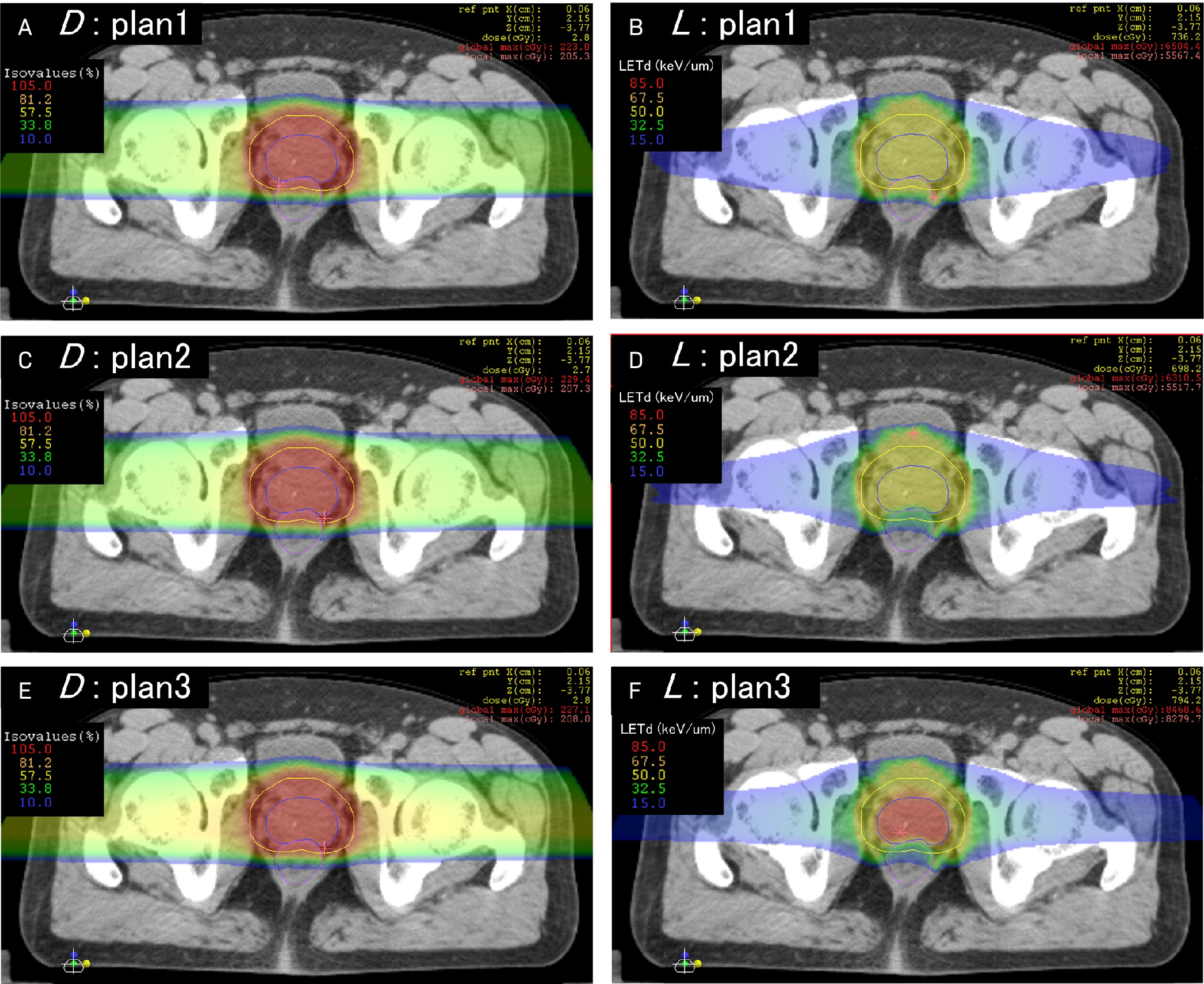 Representative linear energy transfer (LET) painting case reprinted with permission from Inaniwa et al.6 The left column represents RBE-weighted dose (D), and the right column represents dose-averaged LET (L) for 3 prostate cancer plans generated via the intensity-modulated composite particle therapy technique, with panels A-B, C-D, and E-F representing the dose and LET variables for the same plans, respectively. All plans are isodosimetric with variations in LET distribution. Note in plan 1 the uniformly higher LET in the anterior rectum with an aberrant LET hot spot along the left anterolateral rectal wall, outside the target, that would go undetected on pure dosimetric analysis. The LET distribution to the organs at risk is corrected in plans 2 and 3, and LET to the target is successfully escalated isodosimetrically in plan 3.