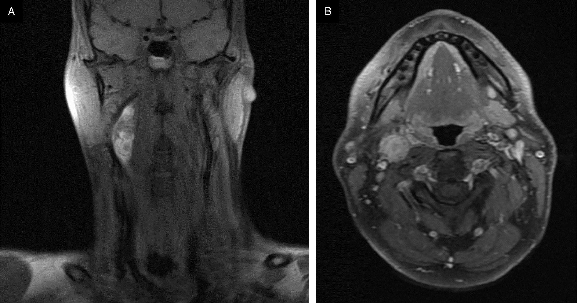 Preoperative MRI of the neck showing axial and coronal postcontrast, fat-saturated T1 sequences and demonstrating an enhancing lesion in the right carotid space.