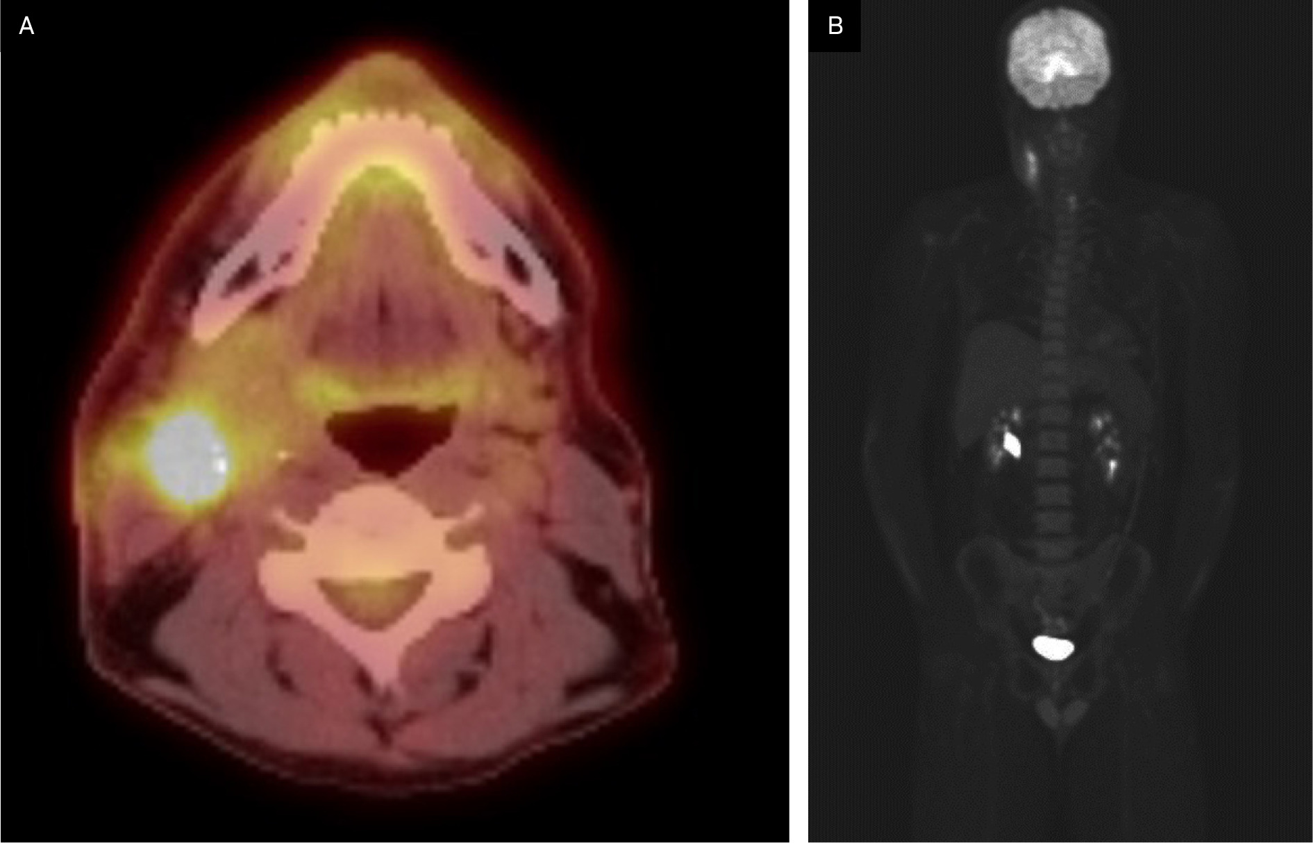 Preoperative F-18 fluorodeoxyglucose (FDG) PET-CT demonstrating FDG-avid lesions.