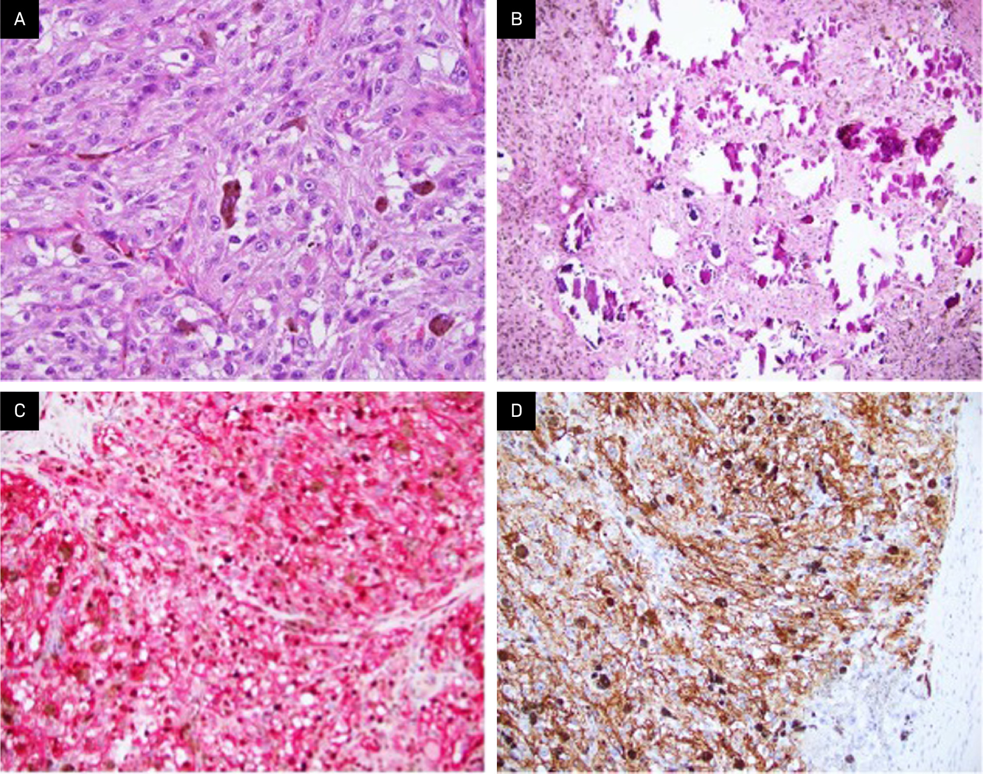 Examination shows fascicles of large epithelioid cells with pigmented cytoplasm and prominent nucleoli, as well as admixed melanophages (A, H&E stain; original magnification: ×400). Psammoma bodies typical of this entity are also identified (B, H&E stain; ×200). Immunohistochemistry reveals the tumor is diffusely and strongly positive for melanocytic markers Melan A (C, red chromogen; × 200) and HMB45 (D, × 200), with Ki67 labeling fewer than 10% of tumor nuclei with brown chromogen (C, × 200).