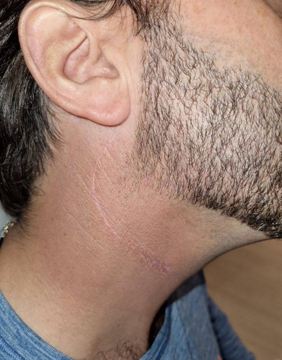 Clinical photograph of the right neck 6 mo post-treatment.