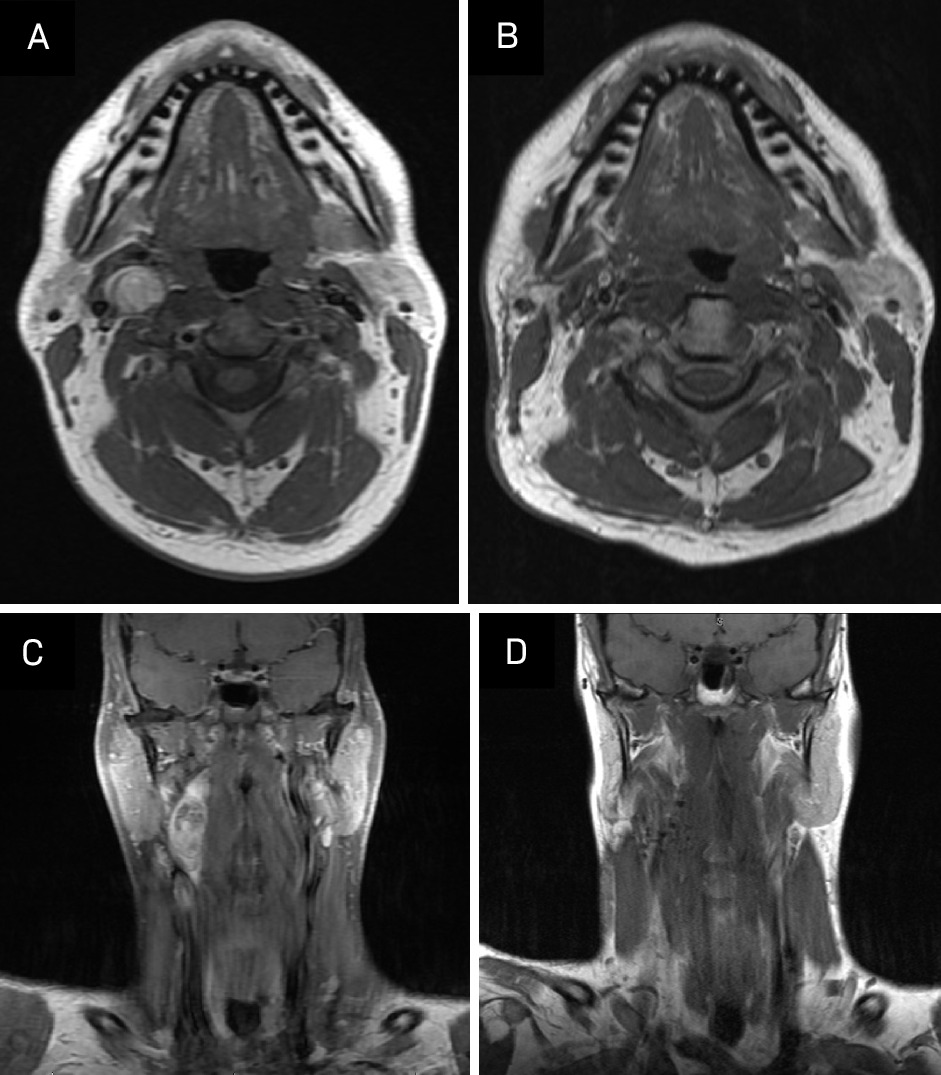 Comparison of pretreatment and post-treatment imaging. (A, C) Pretreatment: T1-weighted fast spin echo (FSE), noncontrast. (B, D) Post-treatment: T1-weighted turbo spin echo (TSE), noncontrast.