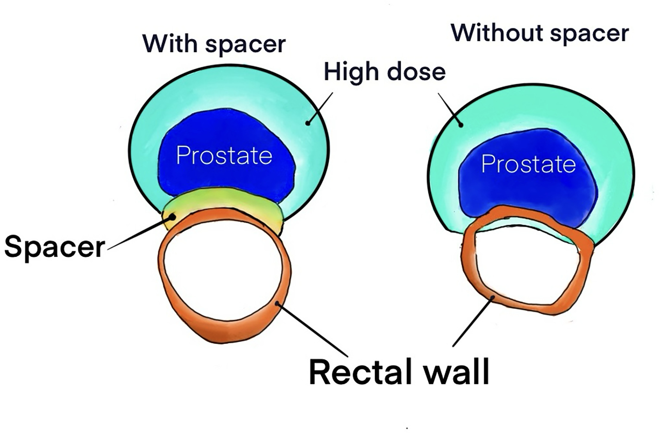 Depiction of the change in received dose to the rectal wall due to ideal polyethylene glycol gel (PEG) spacer placement. PEG is implanted into the perirectal space and creates over 1 cm of space between the prostate and rectal wall.
