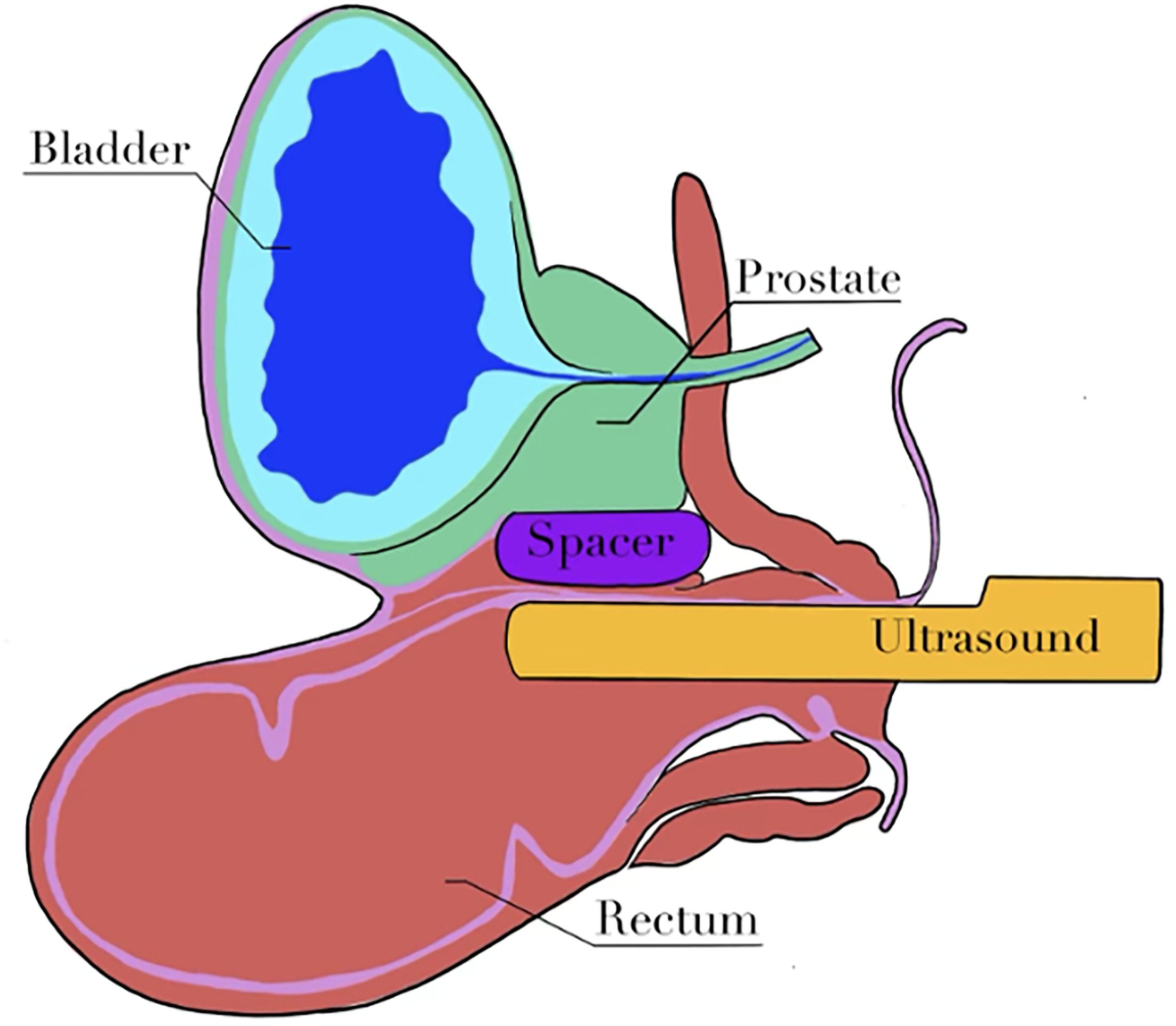 Depiction of the implantation of a rectal displacement device (RDD) into the perirectal space. Ultrasound imaging is used during the procedure to guide and validate RDD placement.