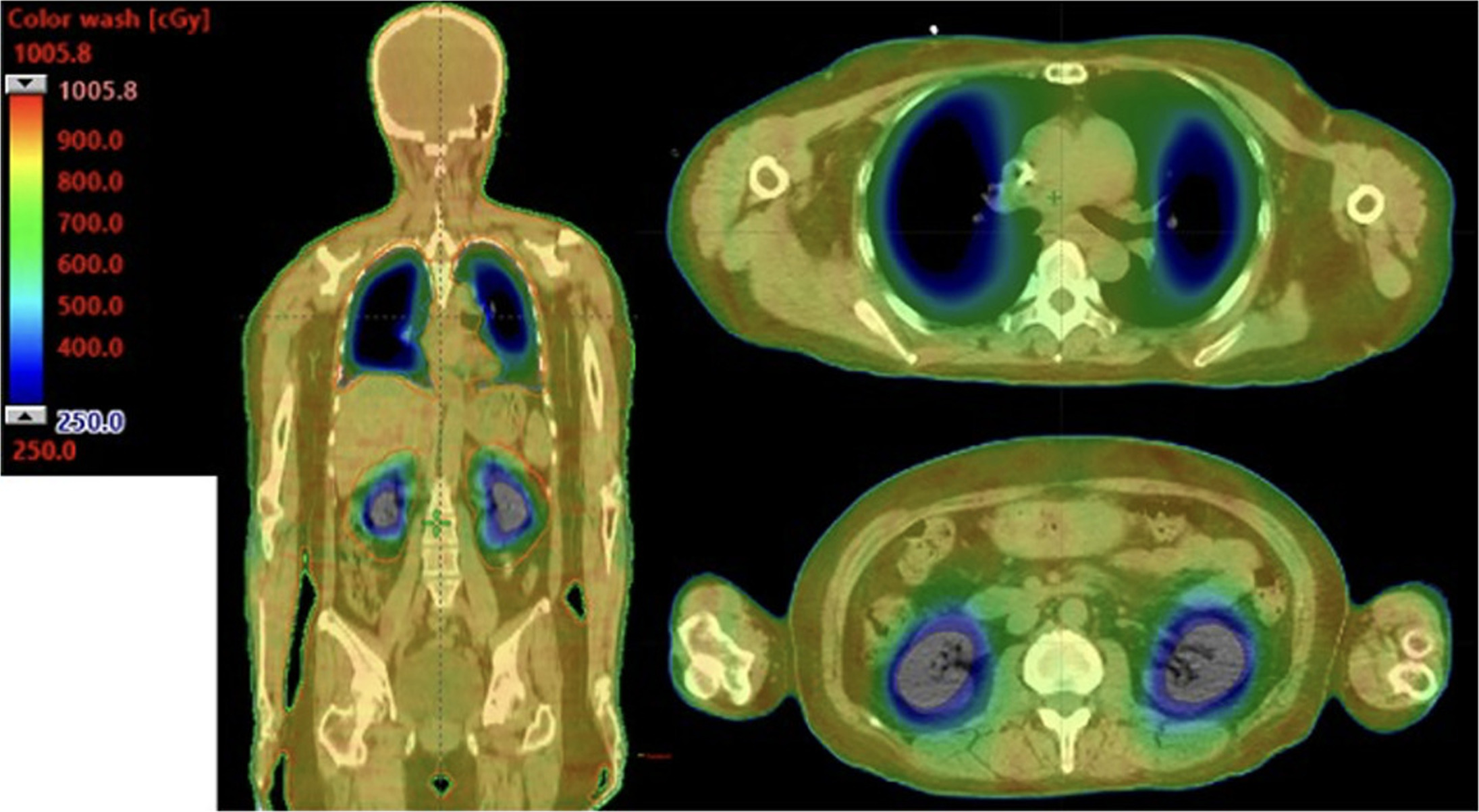 Coronal slices and axial slices from a patient demonstrating the dose distribution implemented in the STAT-2 trial using the VMAT-TBI technique. The visualization of the dose cloud is thresholded to 30% of the prescribed dose (2.5 Gy).