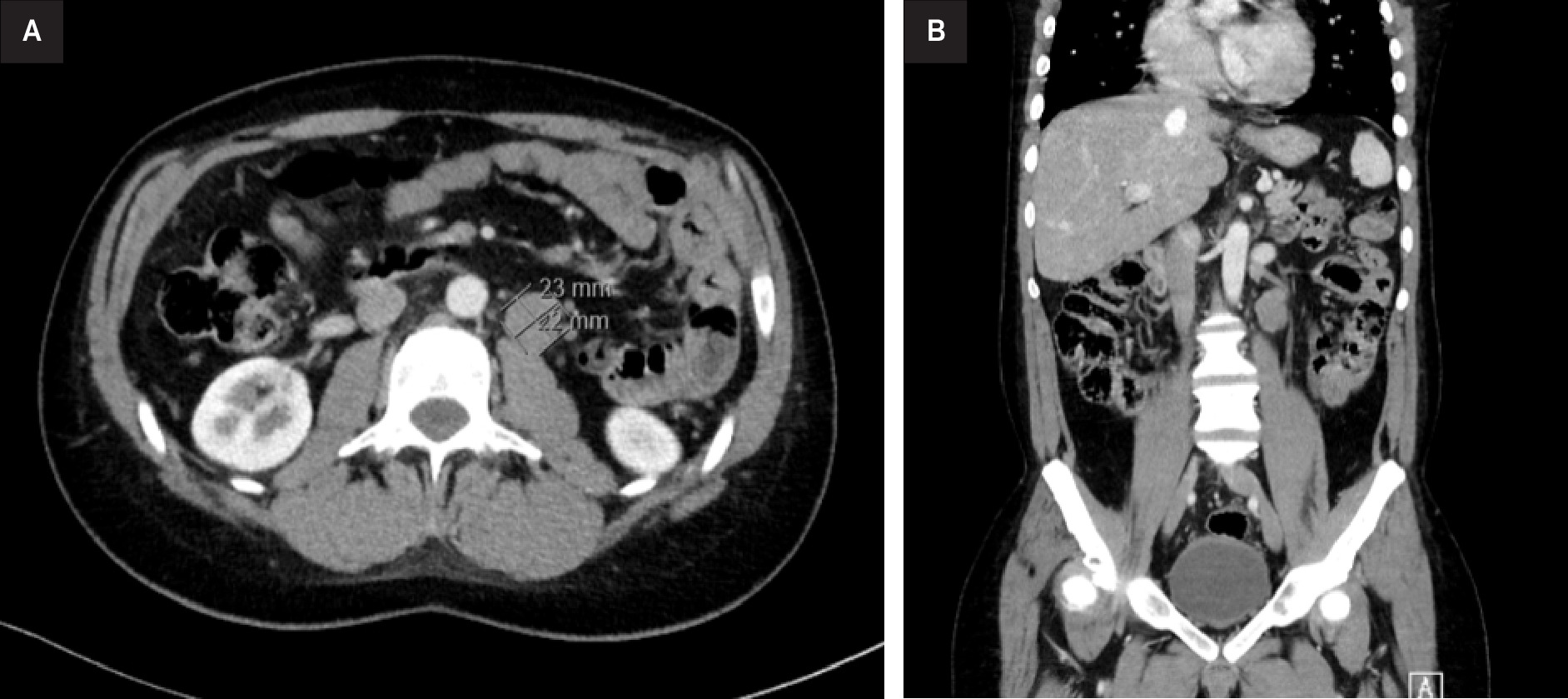 Thoraco-abdominal-pelvic CT. axial (left, A) and coronal (right, B) images demonstrate a retroperitoneal left para-aortic lymphadenopathy, located below the renal vein, measuring 20 mm.