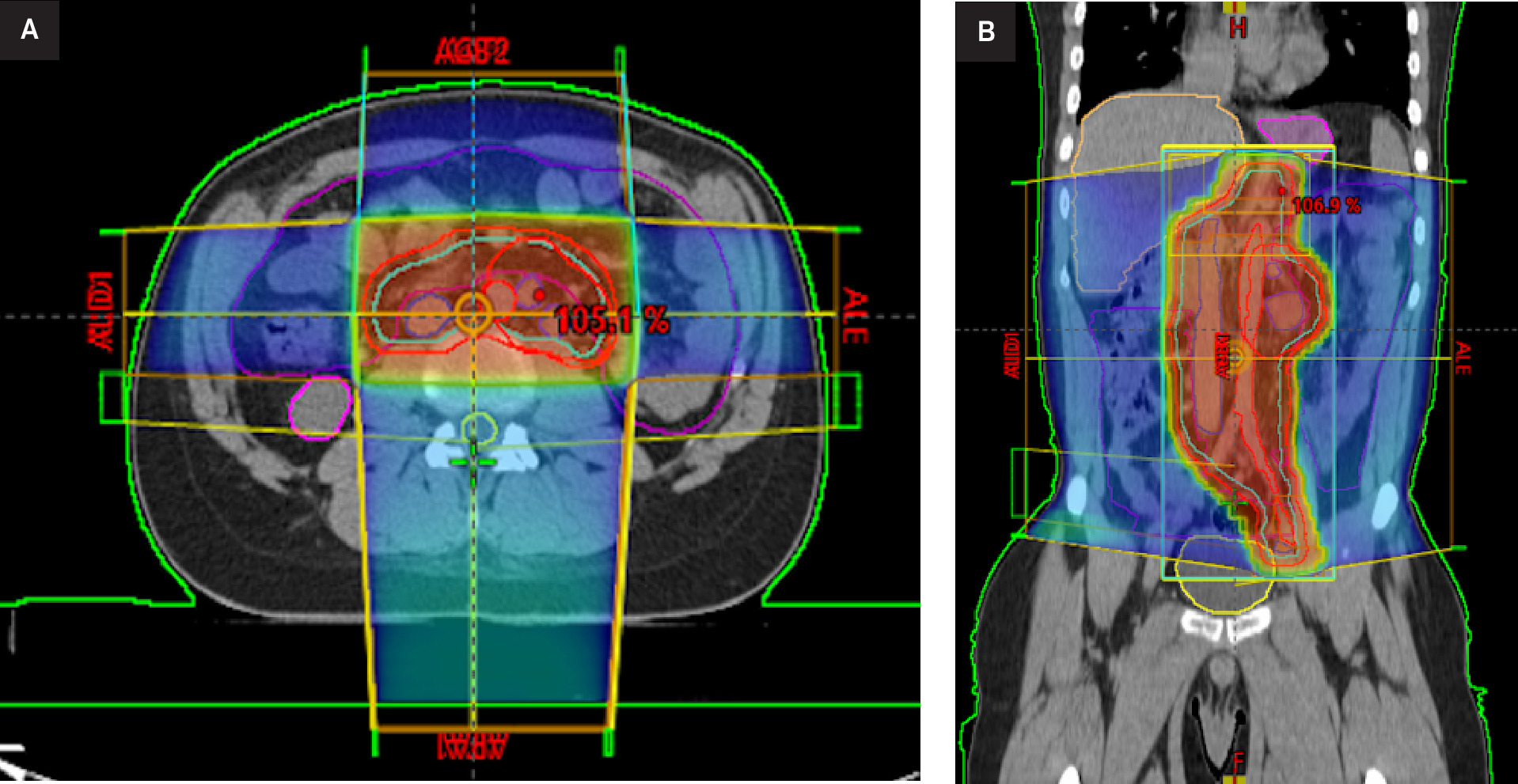External beam radiation therapy treatment planning. Axial (A) and coronal (B) CT images with overlaid dose distribution and target volume (green outline).