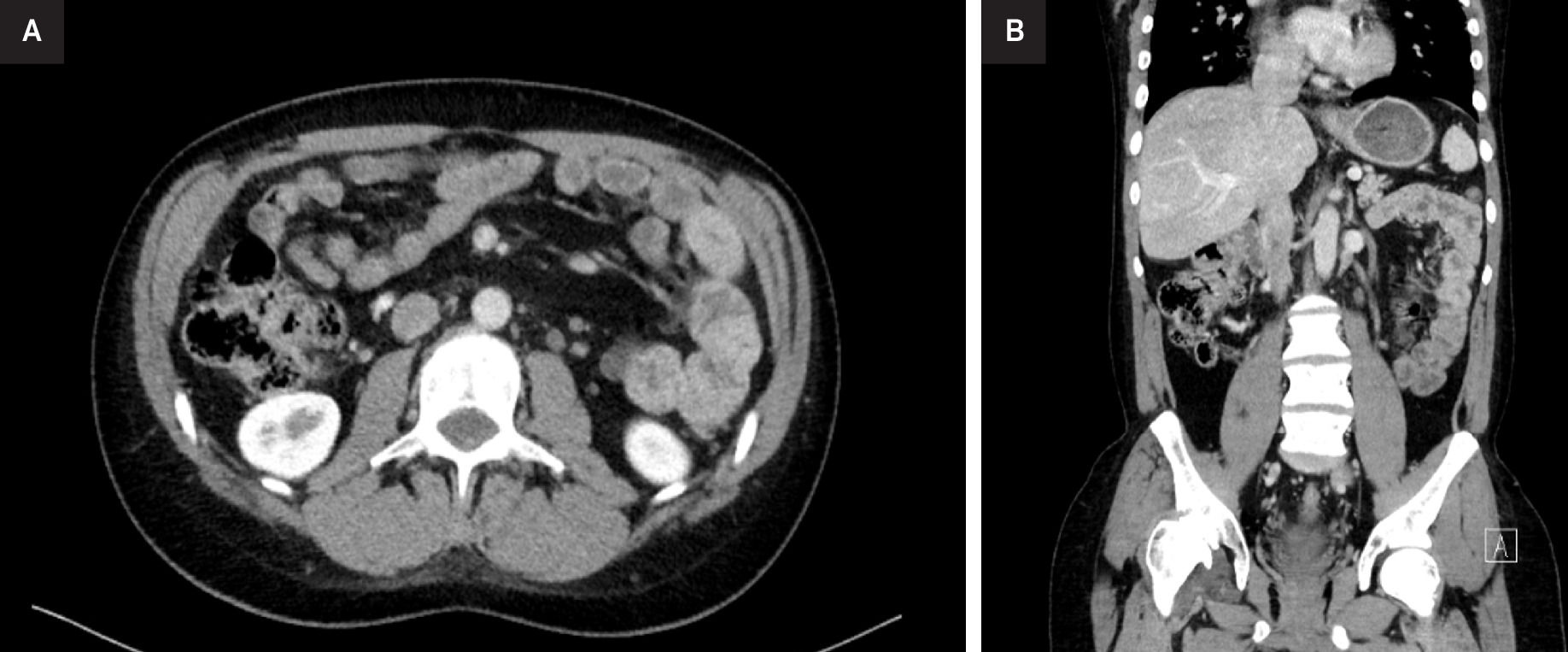 Reassessment thoraco-abdominal CT with 3-dimensional reconstruction at 3 m. Axial (A) and coronal (B) views demonstrate reduction in left lateral aortic adenopathy (now measuring 13 × 10 mm) with disappearance of previously identified metastatic lymph nodes.