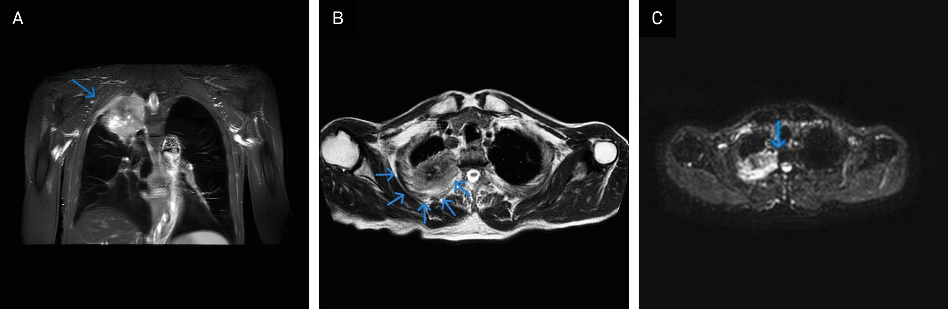 Thoracic MRI demonstrating Pancoast syndrome due to involvement of the right upper lung lobe. Coronal plane (A), axial plane (B), and axial plane showing suspected vertebral infiltration (blue arrow) (C).