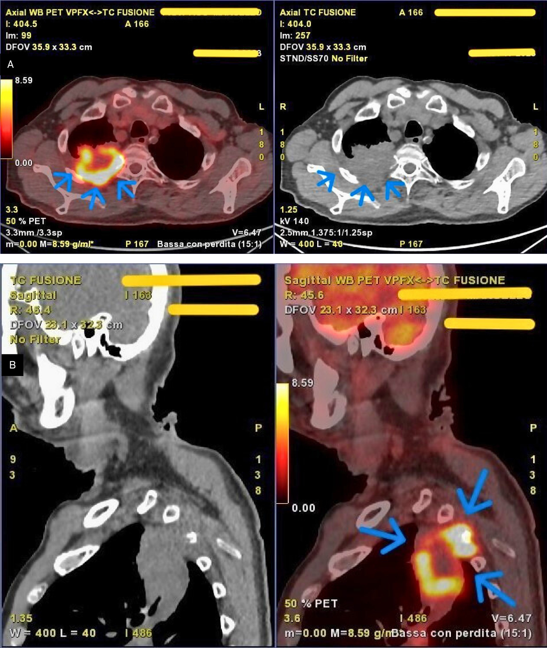 PET-CT demonstrating an excavated lesion infiltrating the ribs in the right upper lung lobe. Axial view (A) and sagittal view (B).