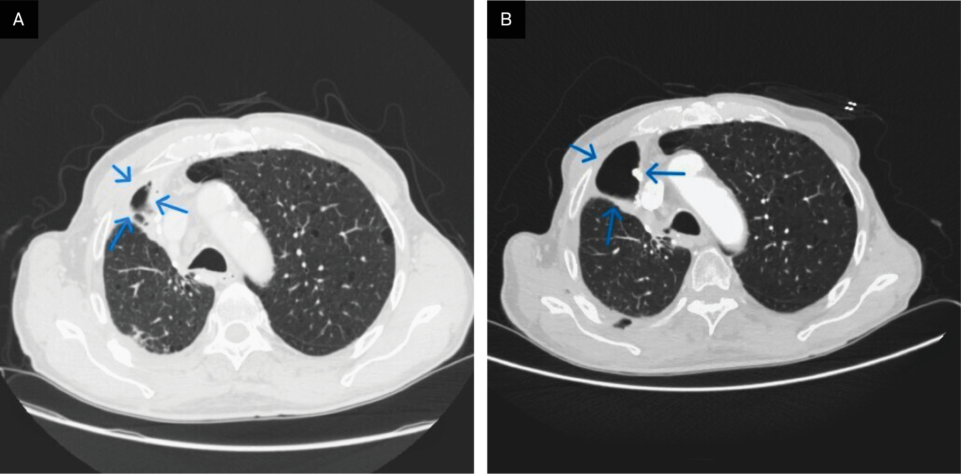 Routine postoperative CT demonstrating right-sided hydropneumothorax. Upper axial plane (blue arrows) (A) and lower axial plane (blue arrows) (B).