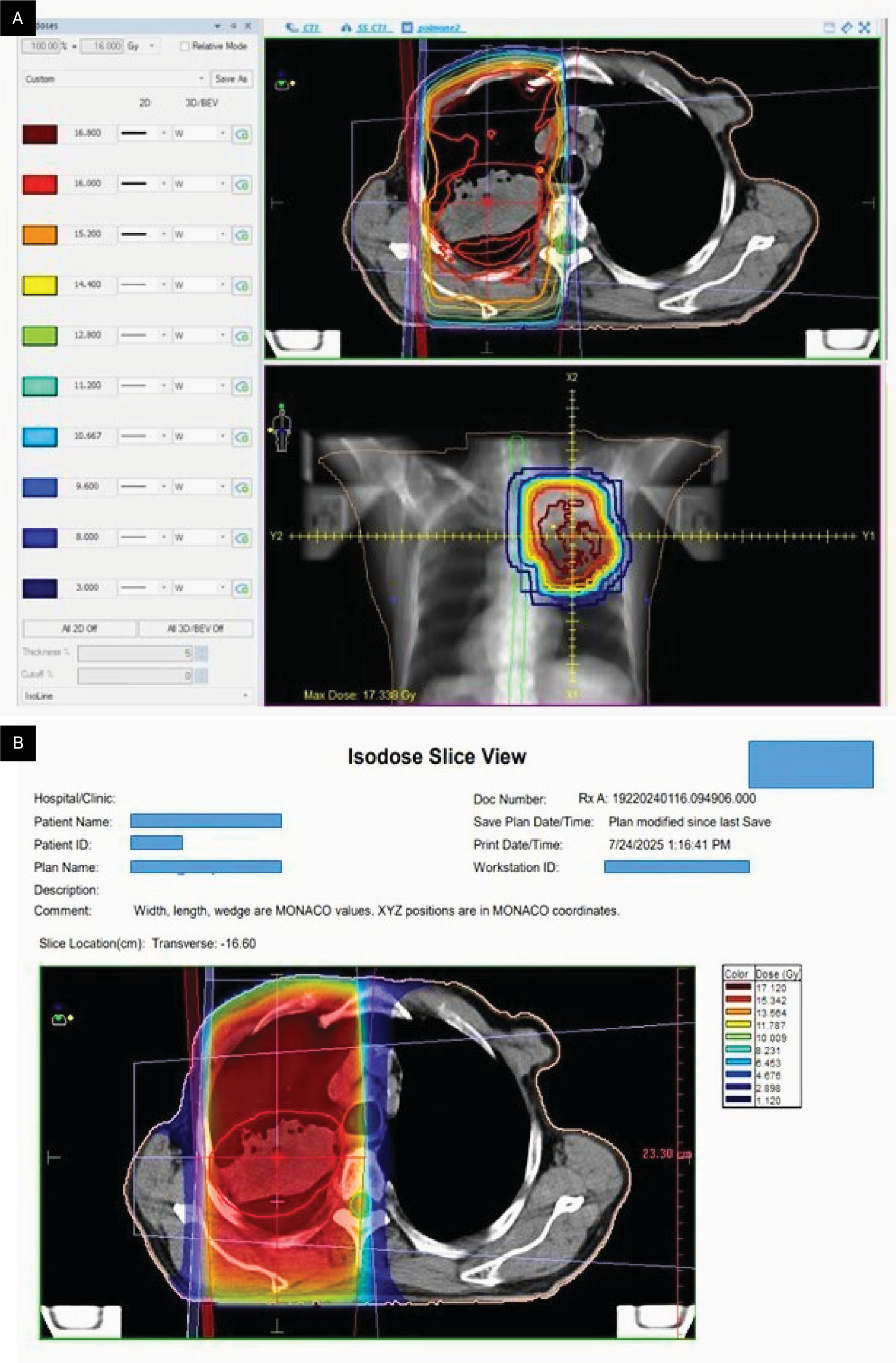 Radiation therapy treatment planning images demonstrating isodose distribution on frontal and axial planes (A) and color wash dose distribution on axial plane (B).