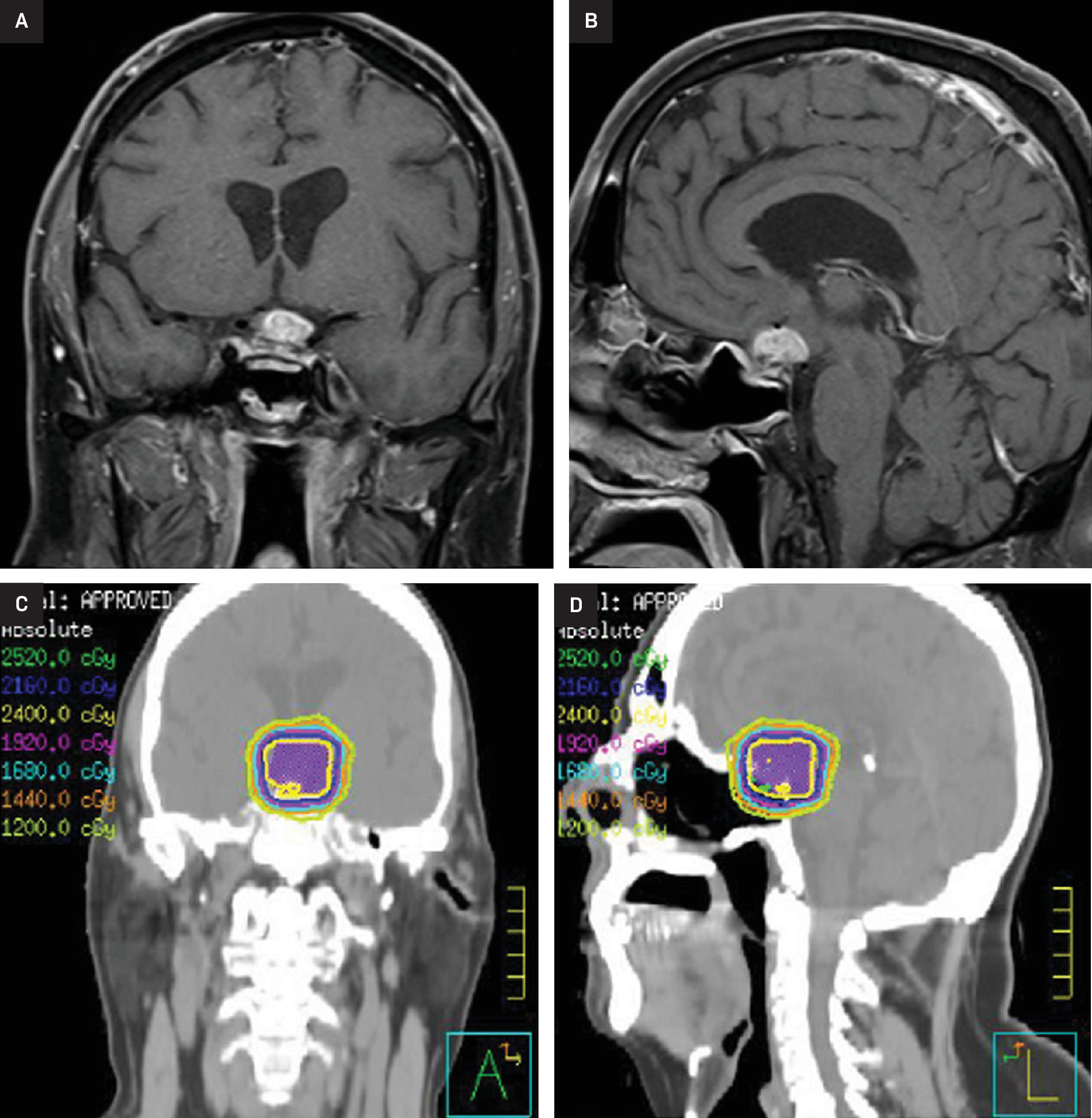 Coronal and sagittal slices of T1-weighted, postcontrast MRI scans of the pituitary gland (A, B). Corresponding radiation therapy (RT) plan for first course of RT, 24 Gy in 12 fractions delivered to the enhancing lesion (C, D).