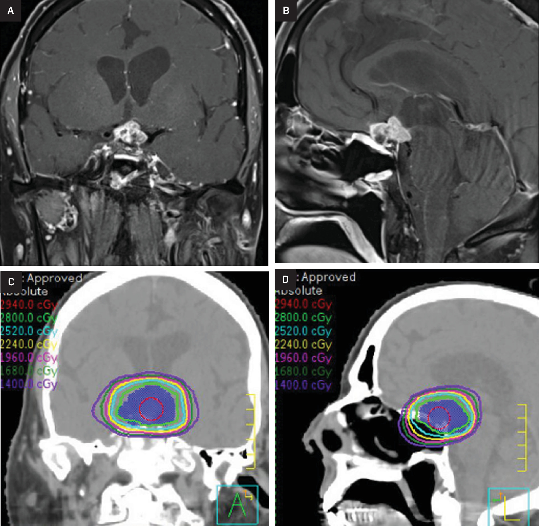 Coronal and sagittal slices of T1-weighted, postcontrast MRI scans of the pituitary gland (A, B). Corresponding radiation therapy (RT) plan for the second course of RT, 28 Gy in 14 fractions delivered to the progressively enhancing lesion (C, D).