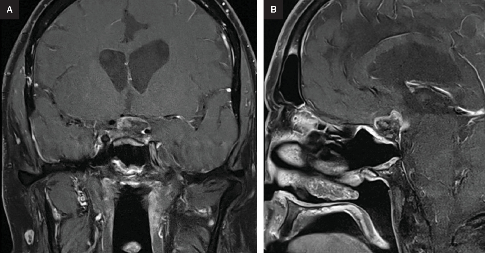 Coronal and sagittal slices of T1-weighted, postcontrast MRI scans of the pituitary gland showing decreased size and enhancement of the suprasellar lesion 6 months post reirradiation (A, B).
