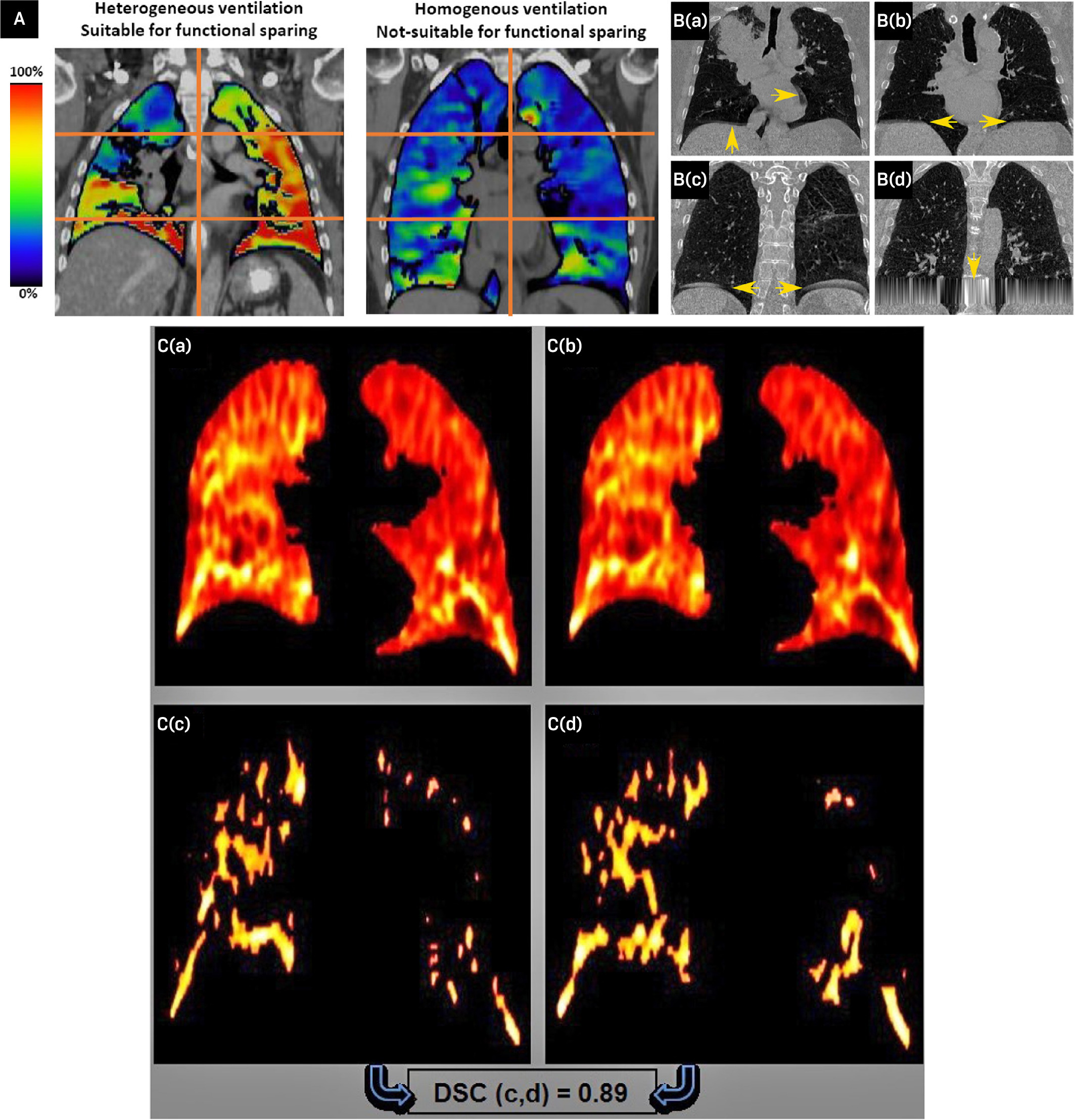 Acceptable vs nonactionable or unreliable imaging scenarios for four-dimensional CT (4DCT) ventilation functional avoidance. Representative published examples showing key patient selection and quality assurance considerations. (A) Homogeneous and heterogeneous 4DCT ventilation patterns overlaid on standard CT. Heterogeneous ventilation may provide a stronger basis for functional avoidance than a homogeneous map. (B) Examples of 4DCT artifacts: (a) misalignment/truncation, (b) truncation, (c) duplication, and (d) interpolation artifact. (C) Algorithm-dependent 4DCT-derived ventilation results: (a) and (b) ventilation images generated using different ventilation algorithms, and (c) and (d) corresponding upper-20% thresholded ventilation volumes. These examples support patient-specific review of 4DCT quality, deformable registration, ventilation map plausibility, and functional heterogeneity before using a map for planning. Adapted from Waxweiler et al, Carrizales et al, and Latifi et al.24,27,28