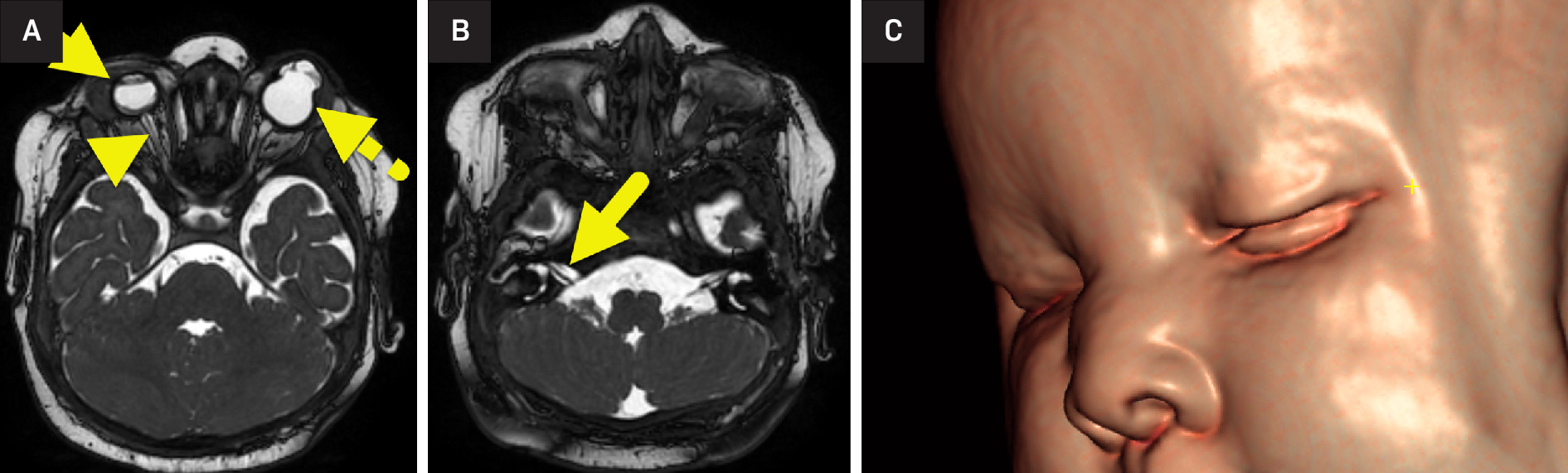 (A) MRI of the orbits shows right microphthalmia (arrow). The anterior chamber of the right globe is small, and the lens is absent. The right retina is detached, and the right optic nerve (arrowhead) is small. The left globe (dashed arrow) had a bilobed appearance with a cystic area extending in the region of the anterior chamber from the rudimentary orbit. (B) Images through the internal auditory canal show small cochlear nerves (arrow). (C) 3D reconstruction of the face shows a depressed nasal bridge.