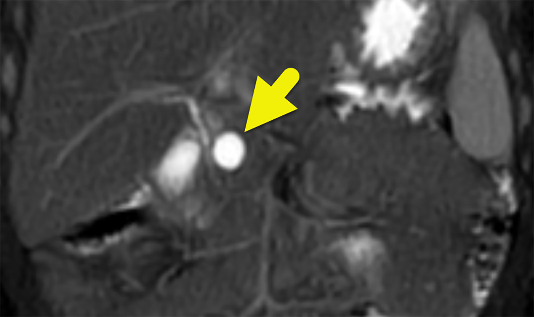 Abdominal MRI shows a cyst (arrow) in the pancreatic head. The cyst did not communicate with the common bile duct. A second cyst was present in the pancreatic tail (not shown).