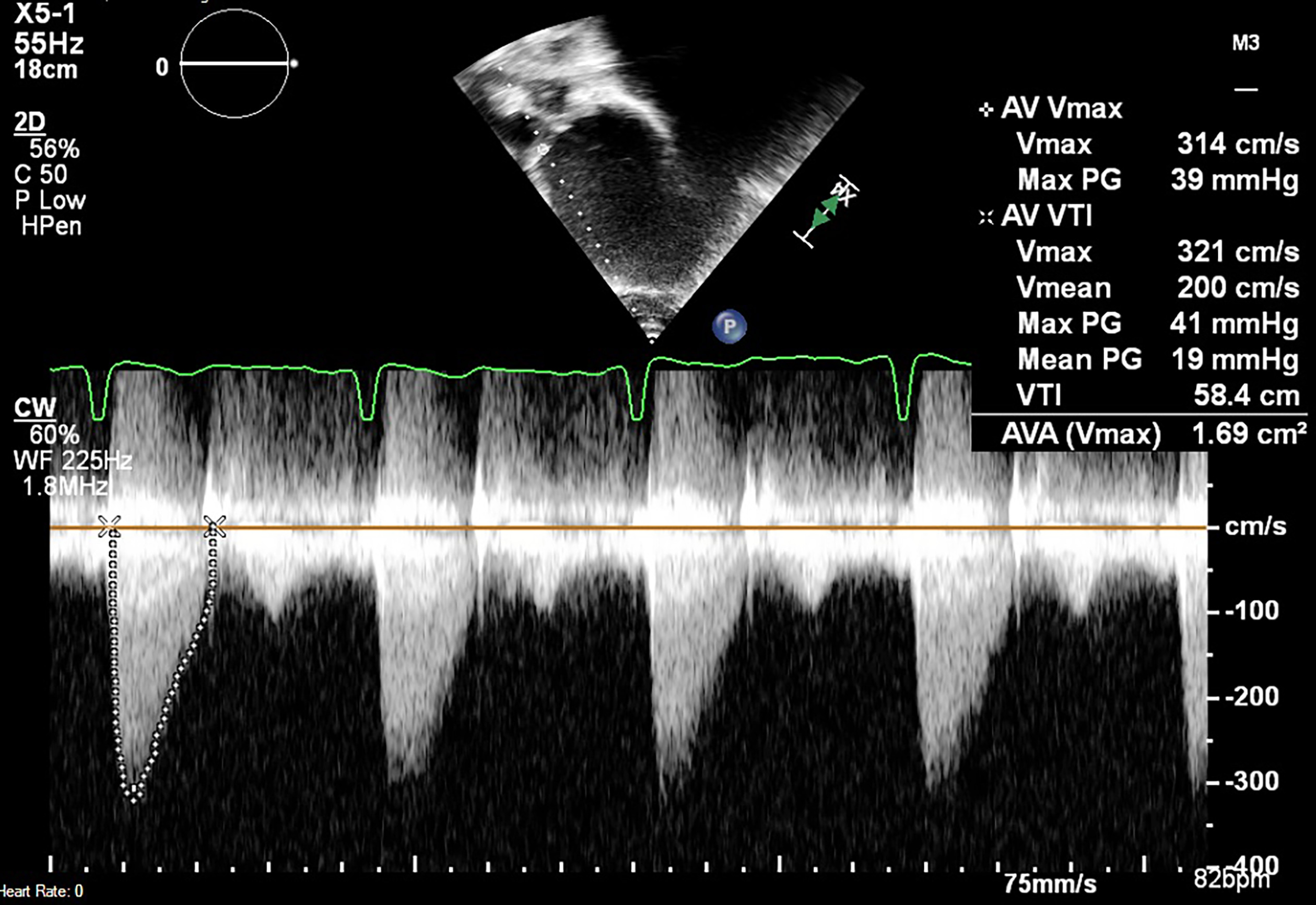Apical 5-chamber transthoracic echocardiogram continuous-wave Doppler across the aortic valve shows a peak velocity of 321 cm/second consistent with moderate aortic valve stenosis.